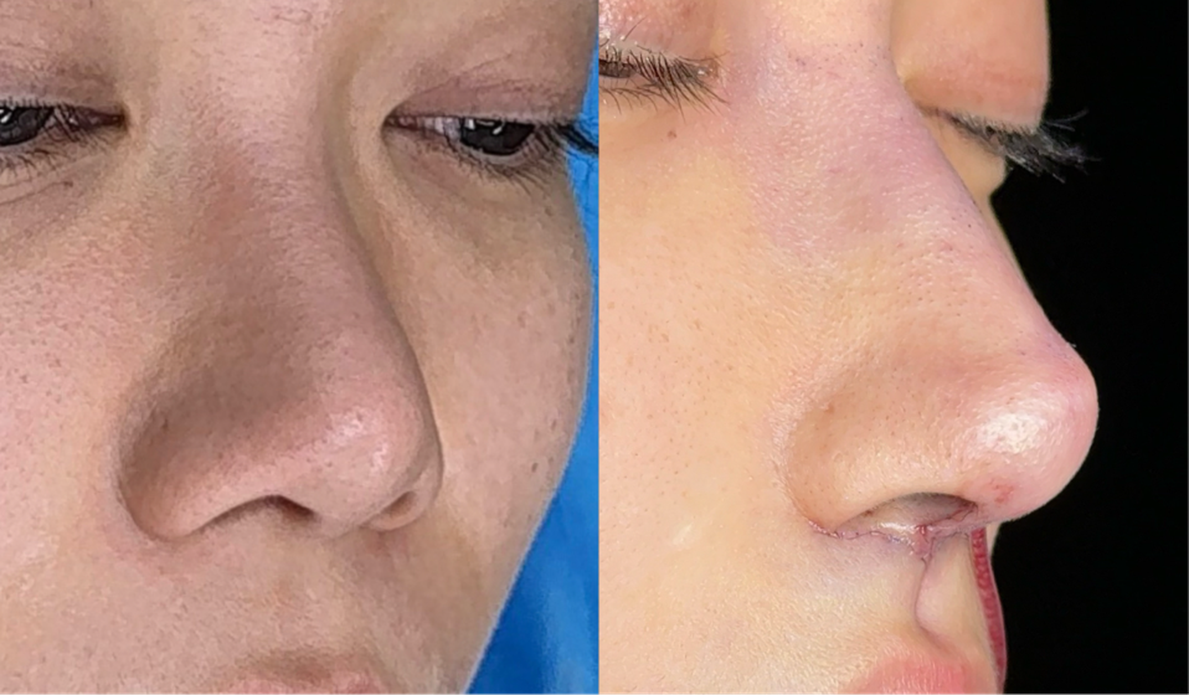 Comprehensive rhinoplasty case 1 before and after