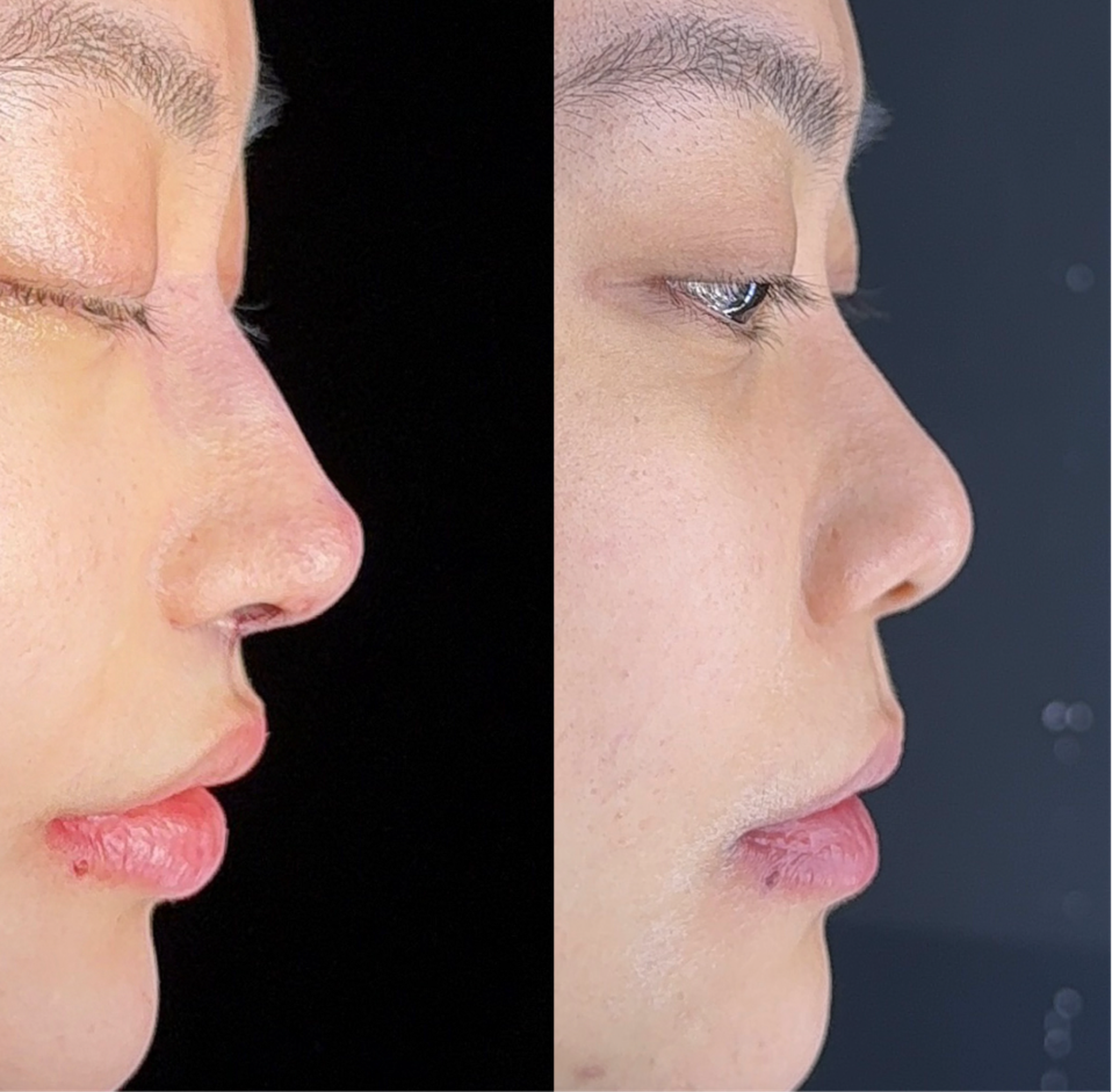 Comprehensive rhinoplasty case 1 additional before and after