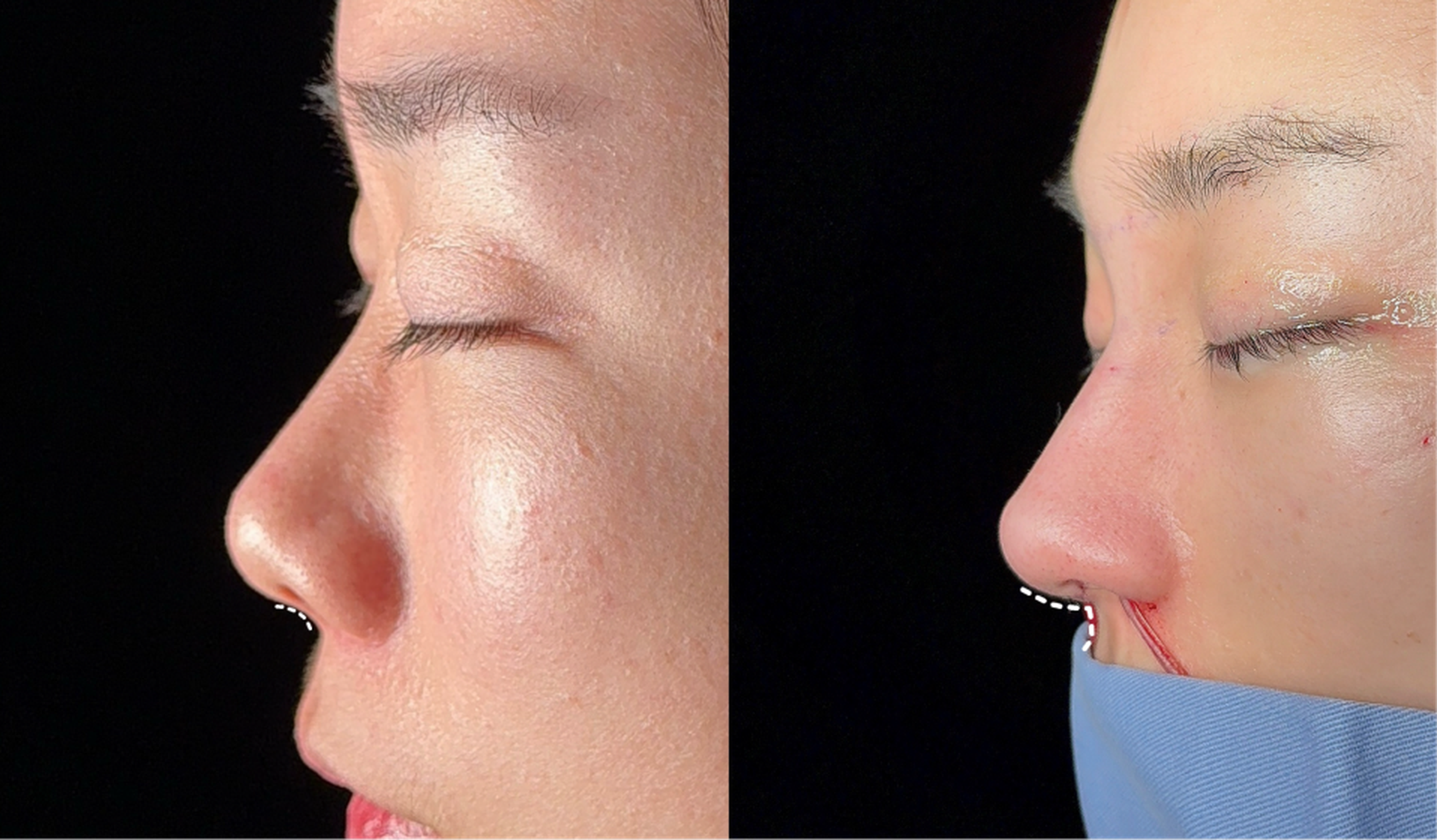 Comprehensive rhinoplasty case 2 before and after