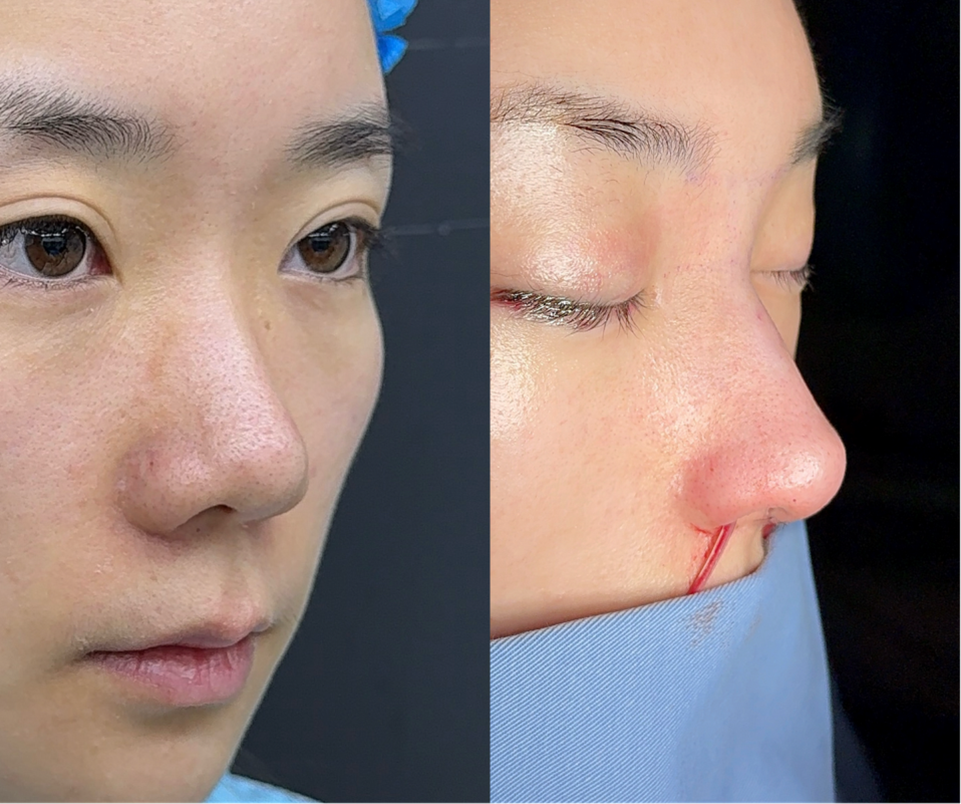 Comprehensive rhinoplasty case 2 additional before and after