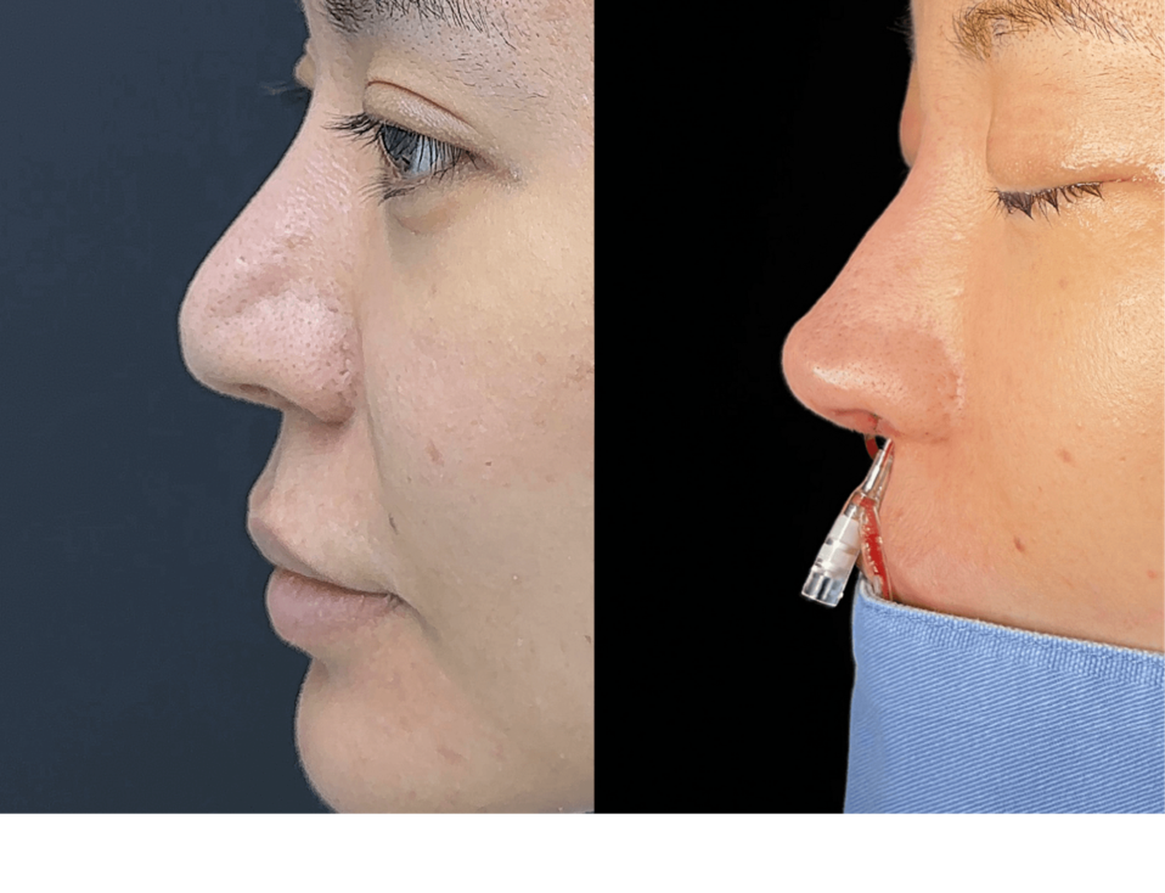 Revision rhinoplasty case 1 before and after