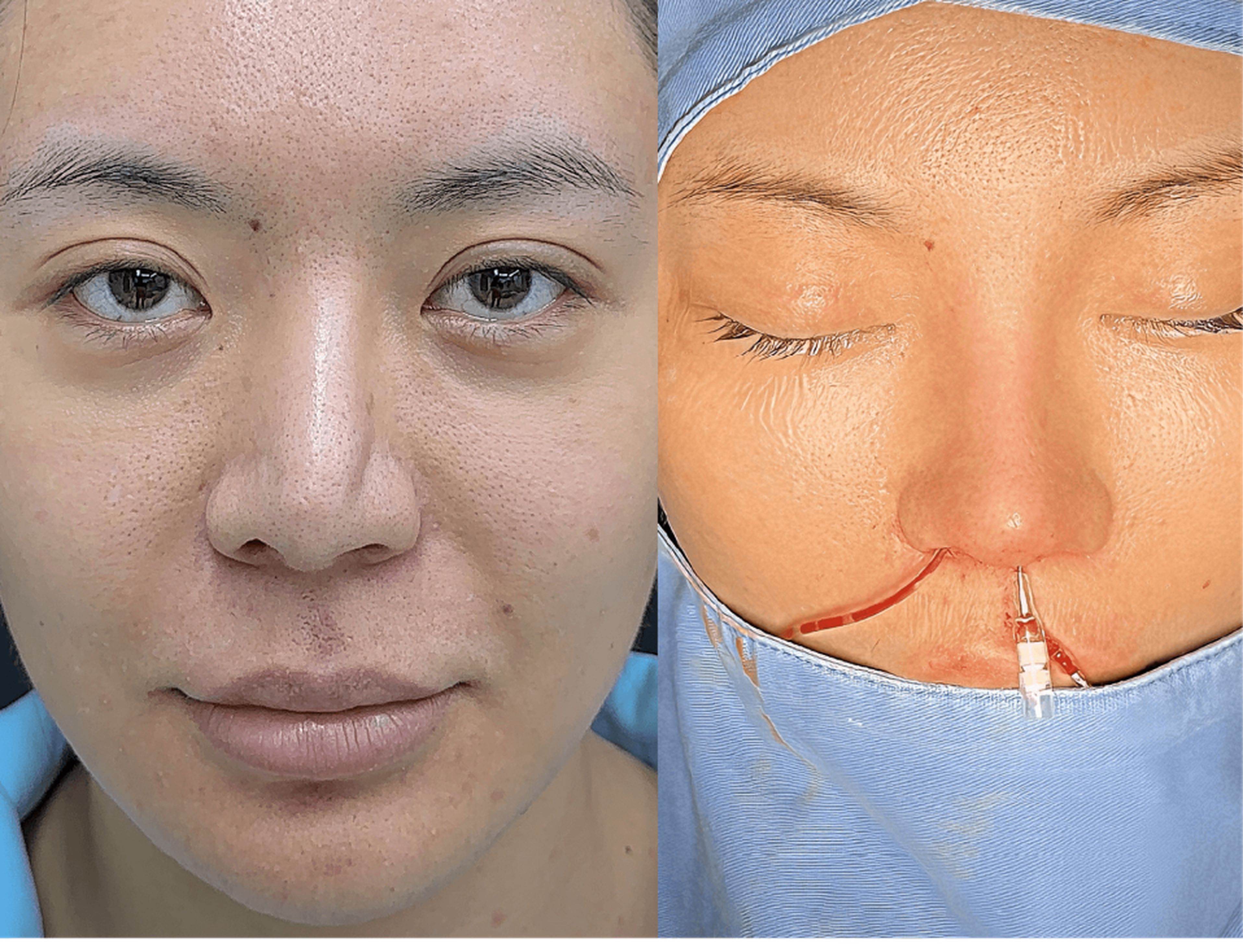 Revision rhinoplasty case 1 additional before and after