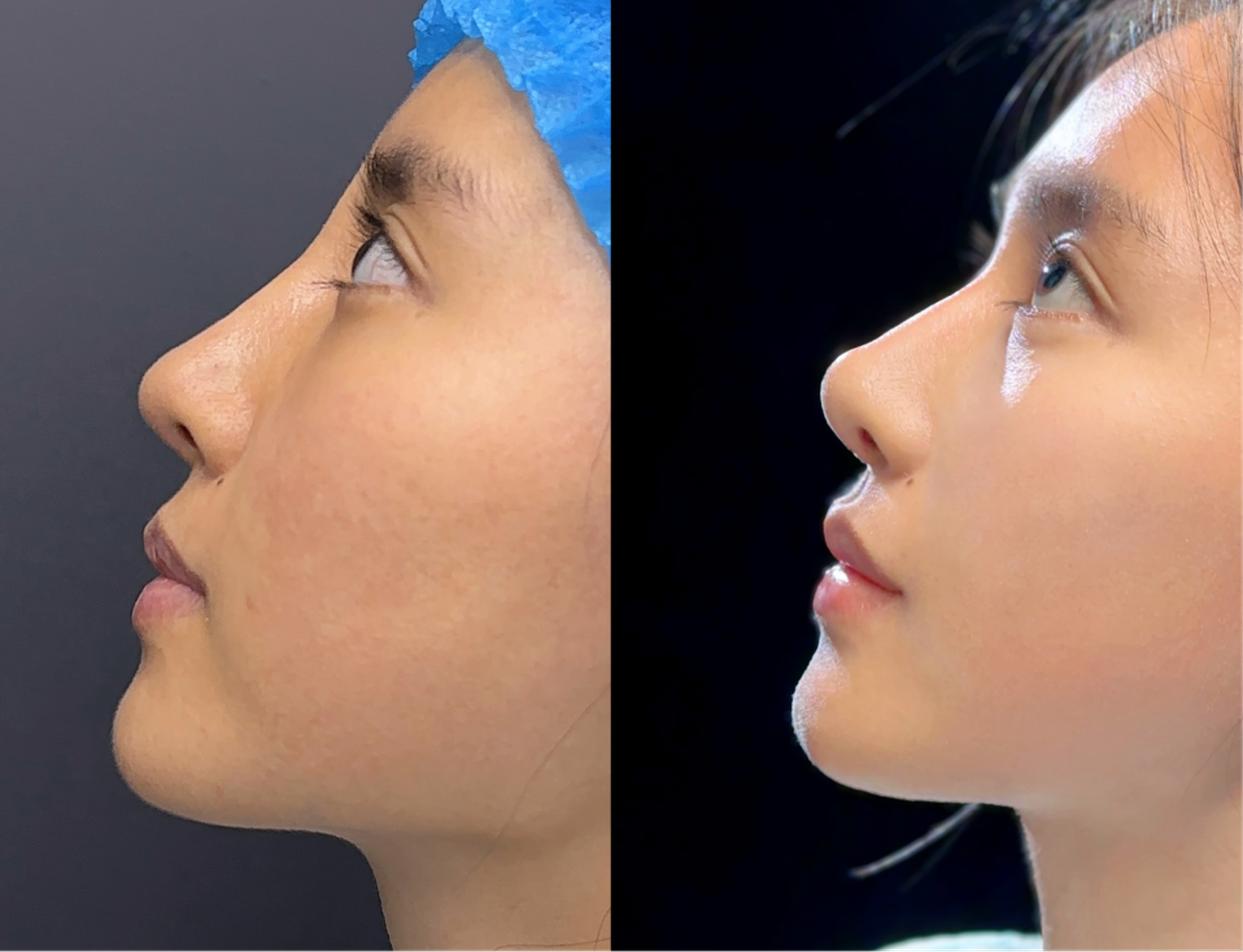 Revision rhinoplasty case 2 before and after