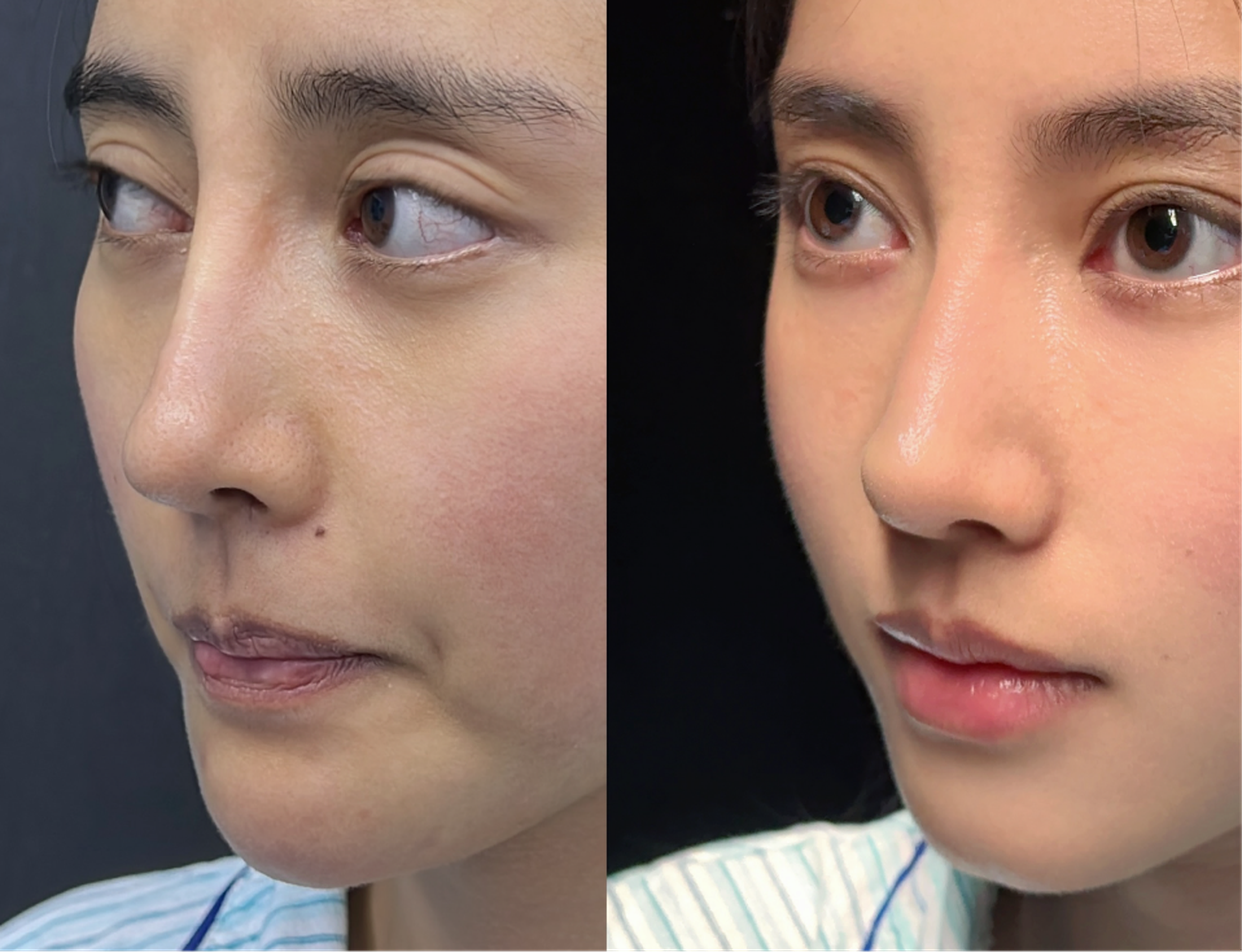 Revision rhinoplasty case 2 additional before and after
