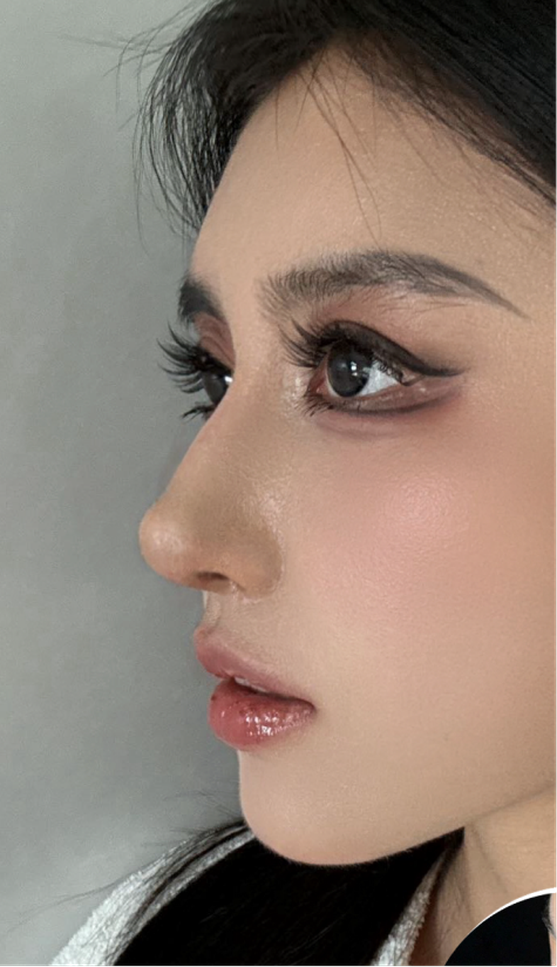 Revision rhinoplasty case 2 feedback left