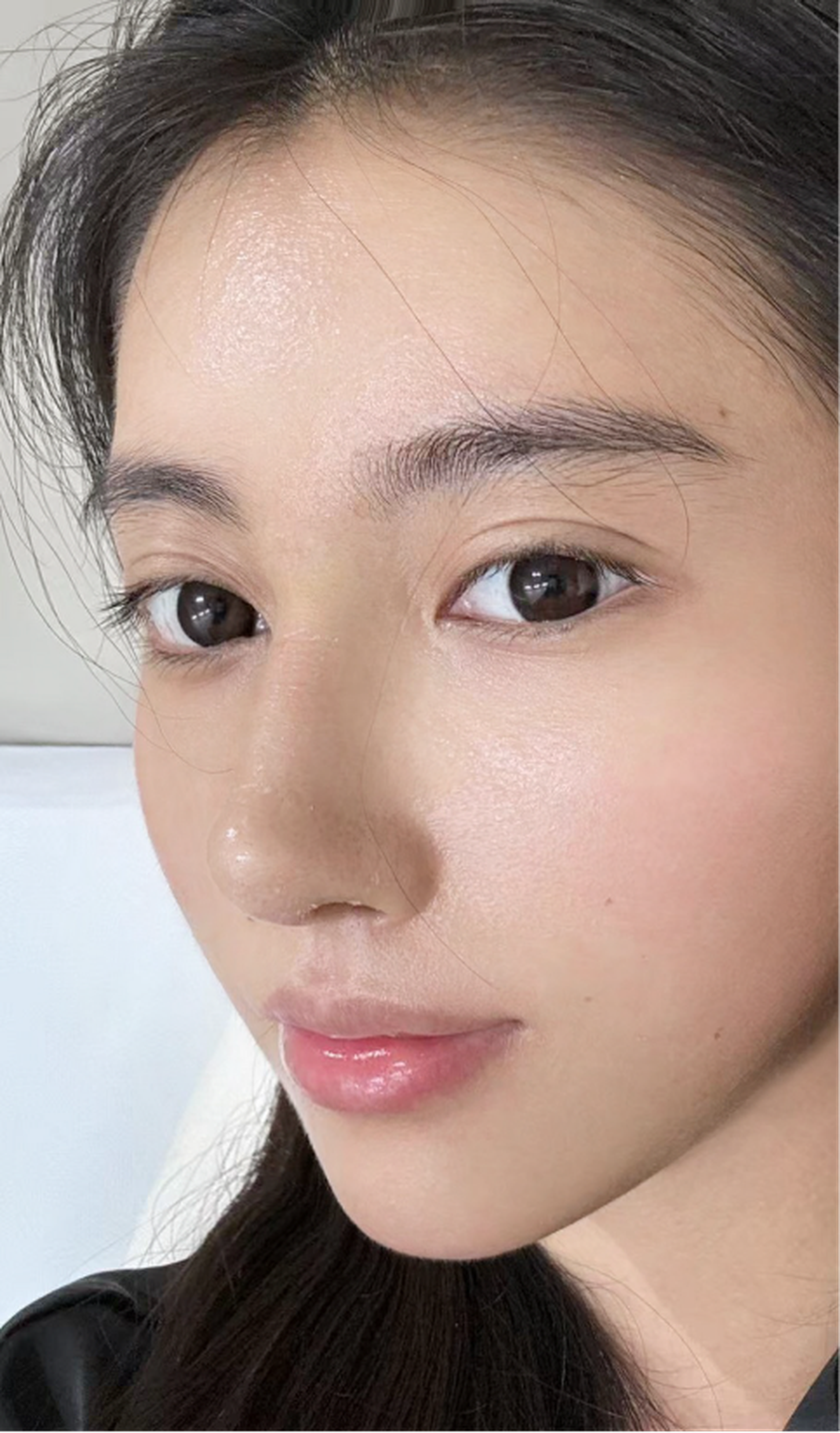 Revision rhinoplasty case 2 feedback right