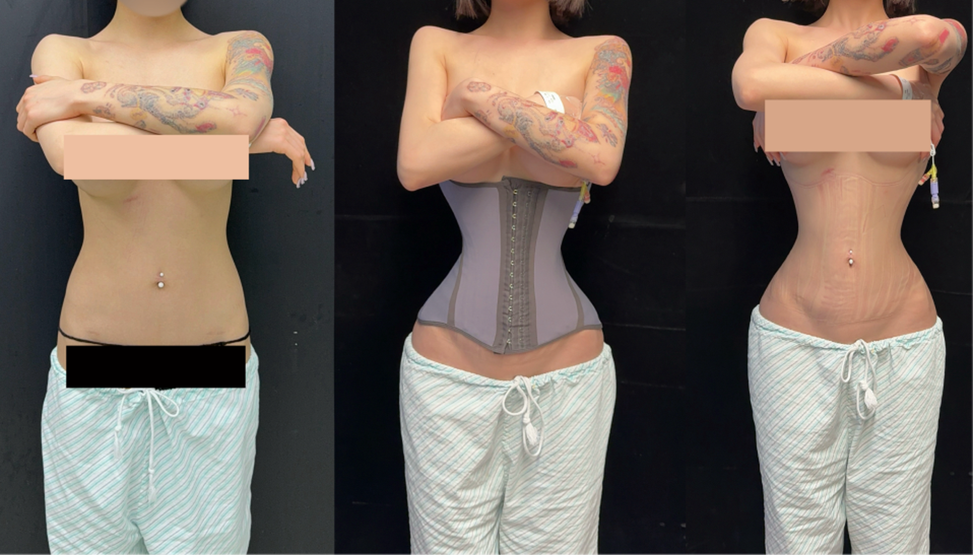 Rib push-in case 1 before and after