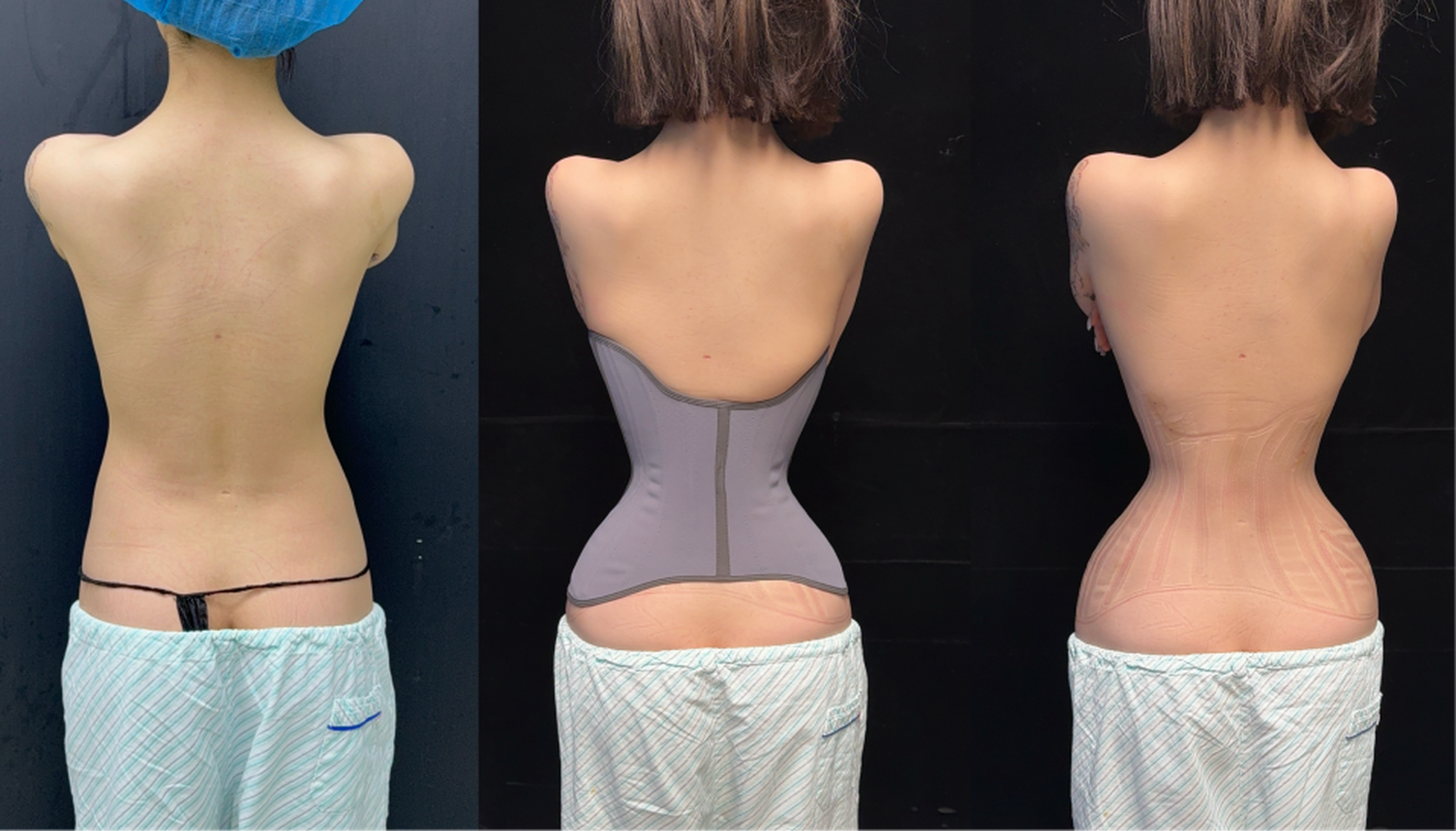 Rib push-in case 1 additional before and after