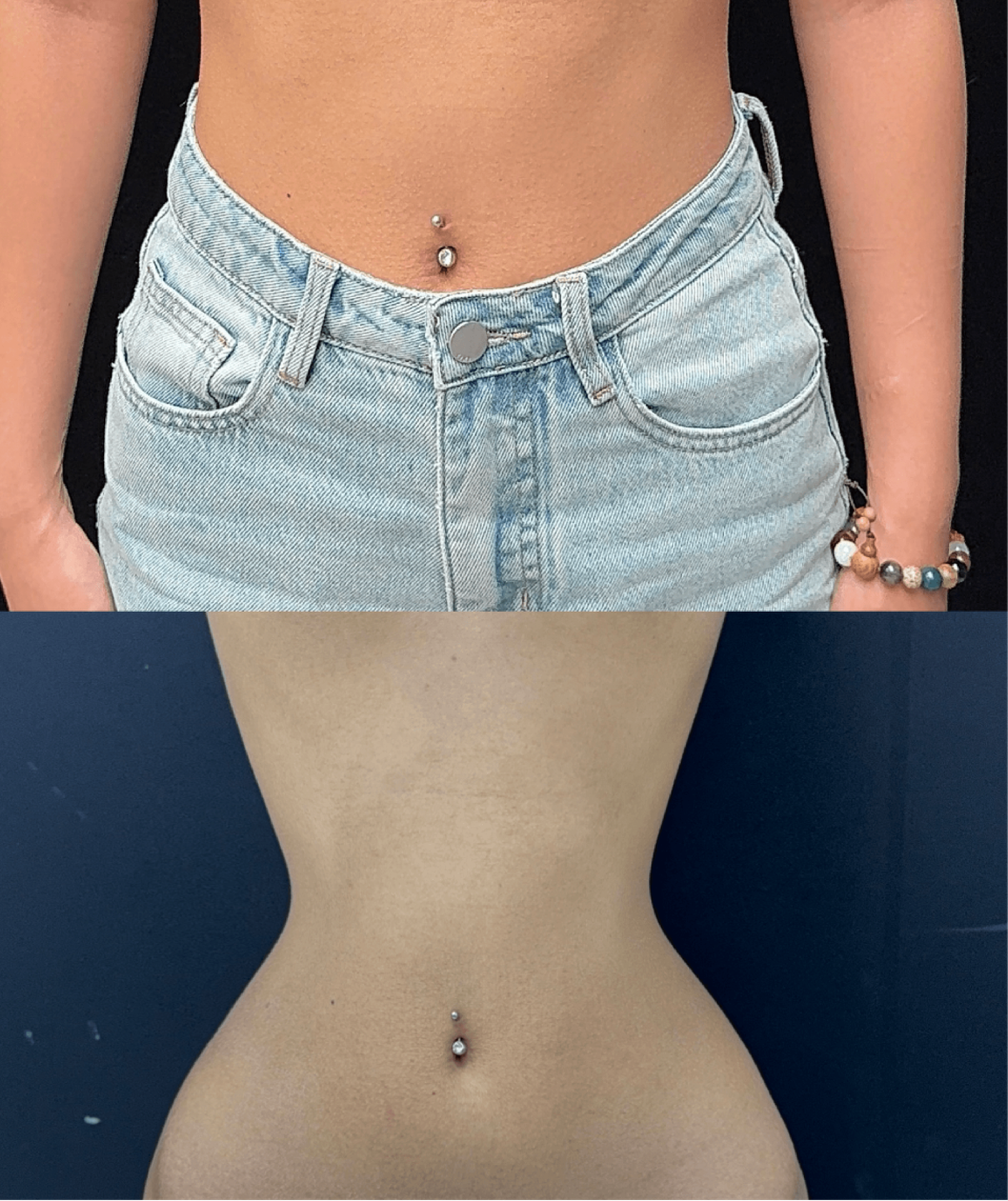 Rib push-in case 2 before and after