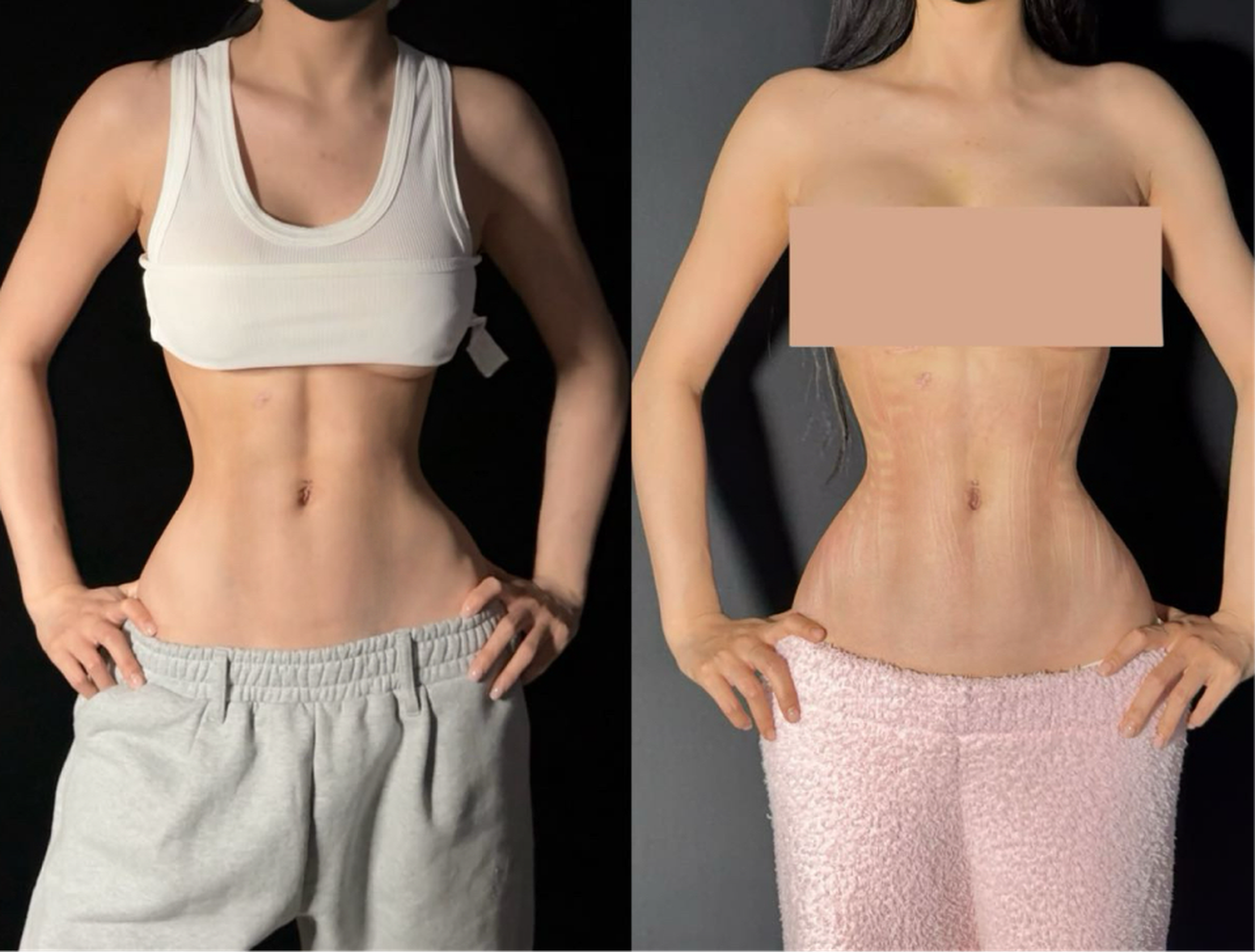 Rib push-in case 3 before and after
