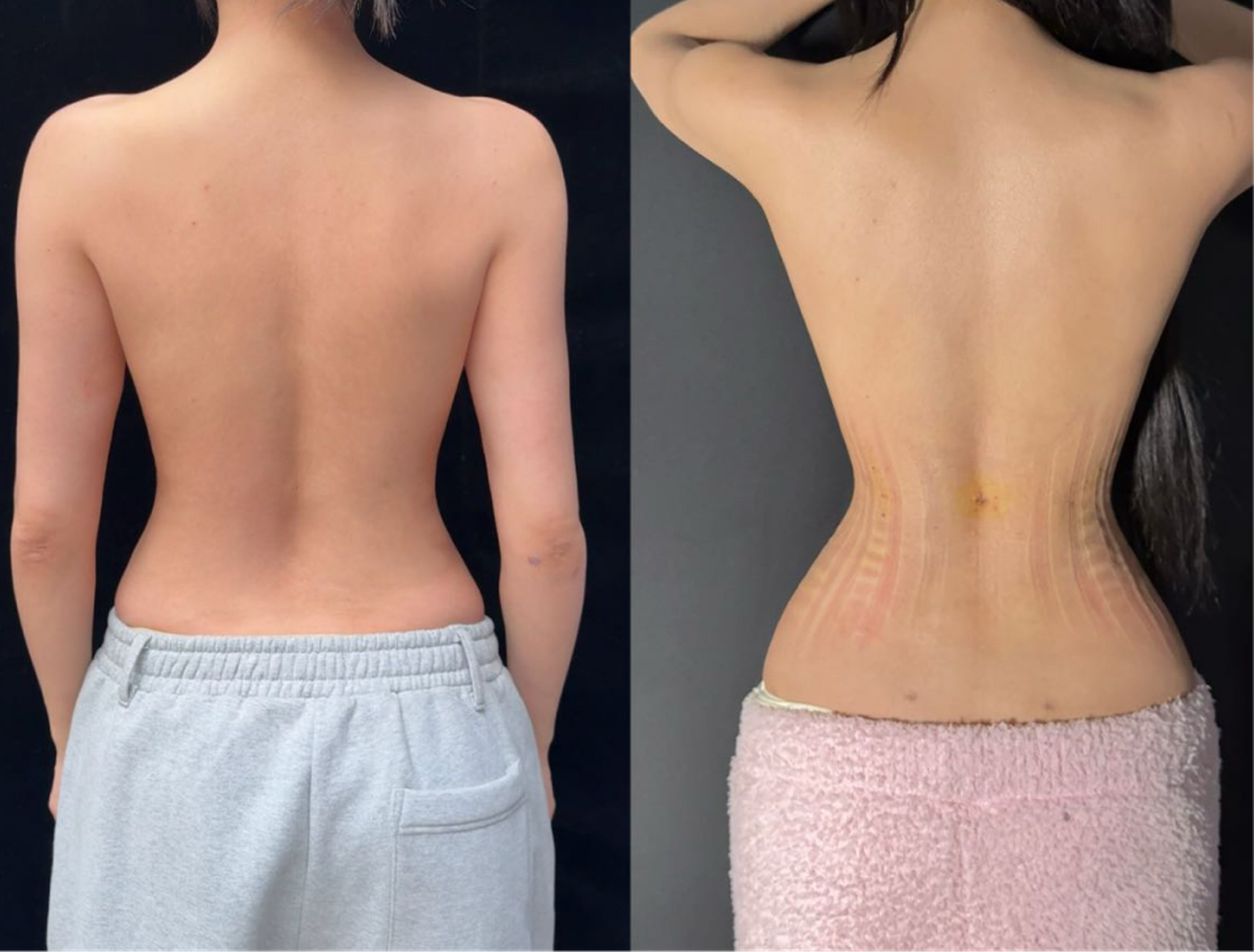 Rib push-in case 3 additional before and after