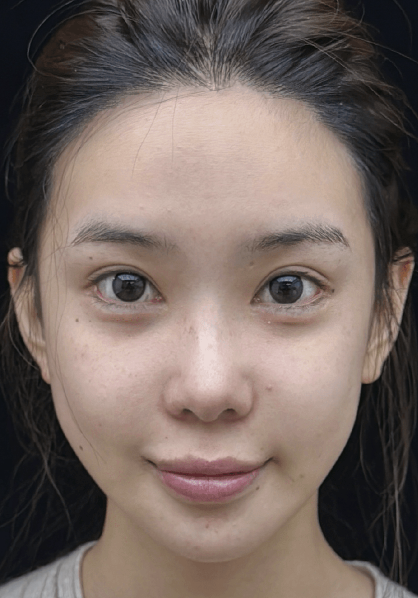 Facial injection after image