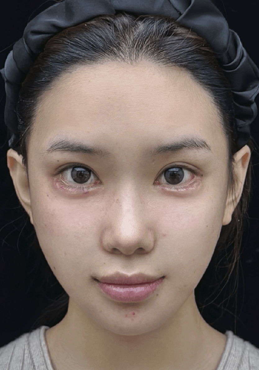 Facial injection before image
