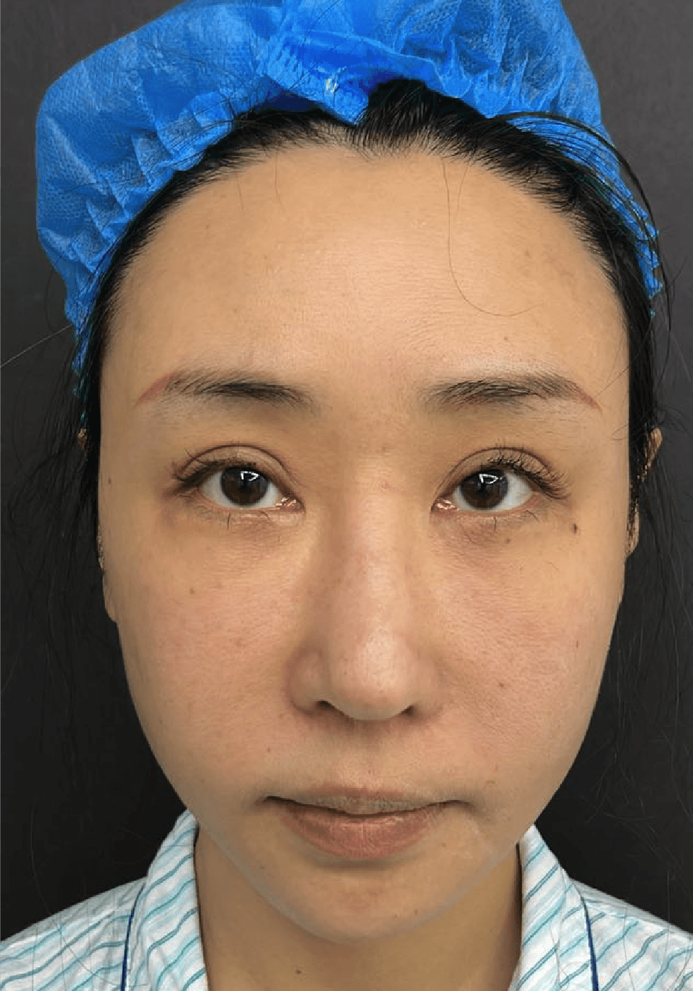 Facial lifting after image