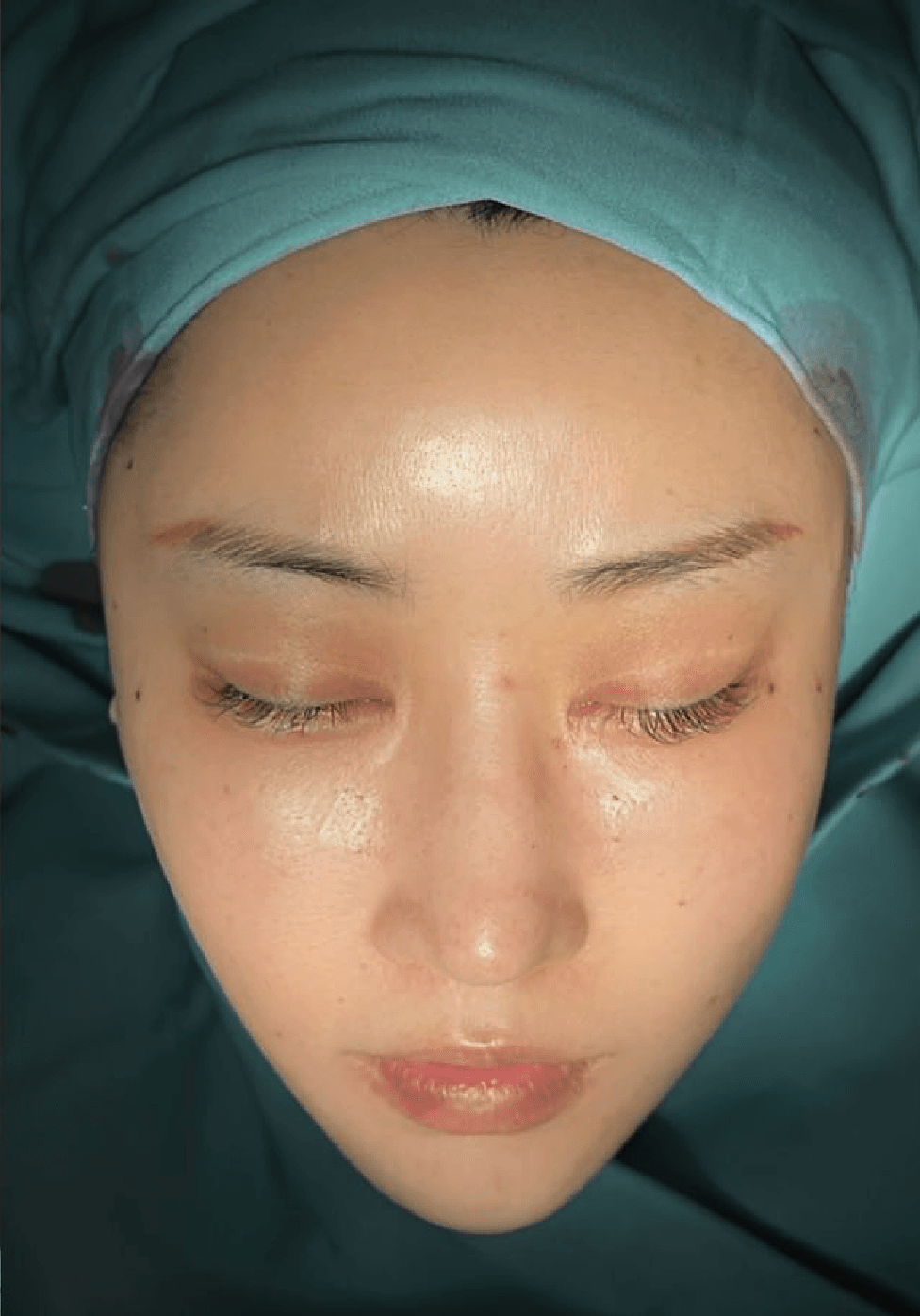 Facial lifting before image