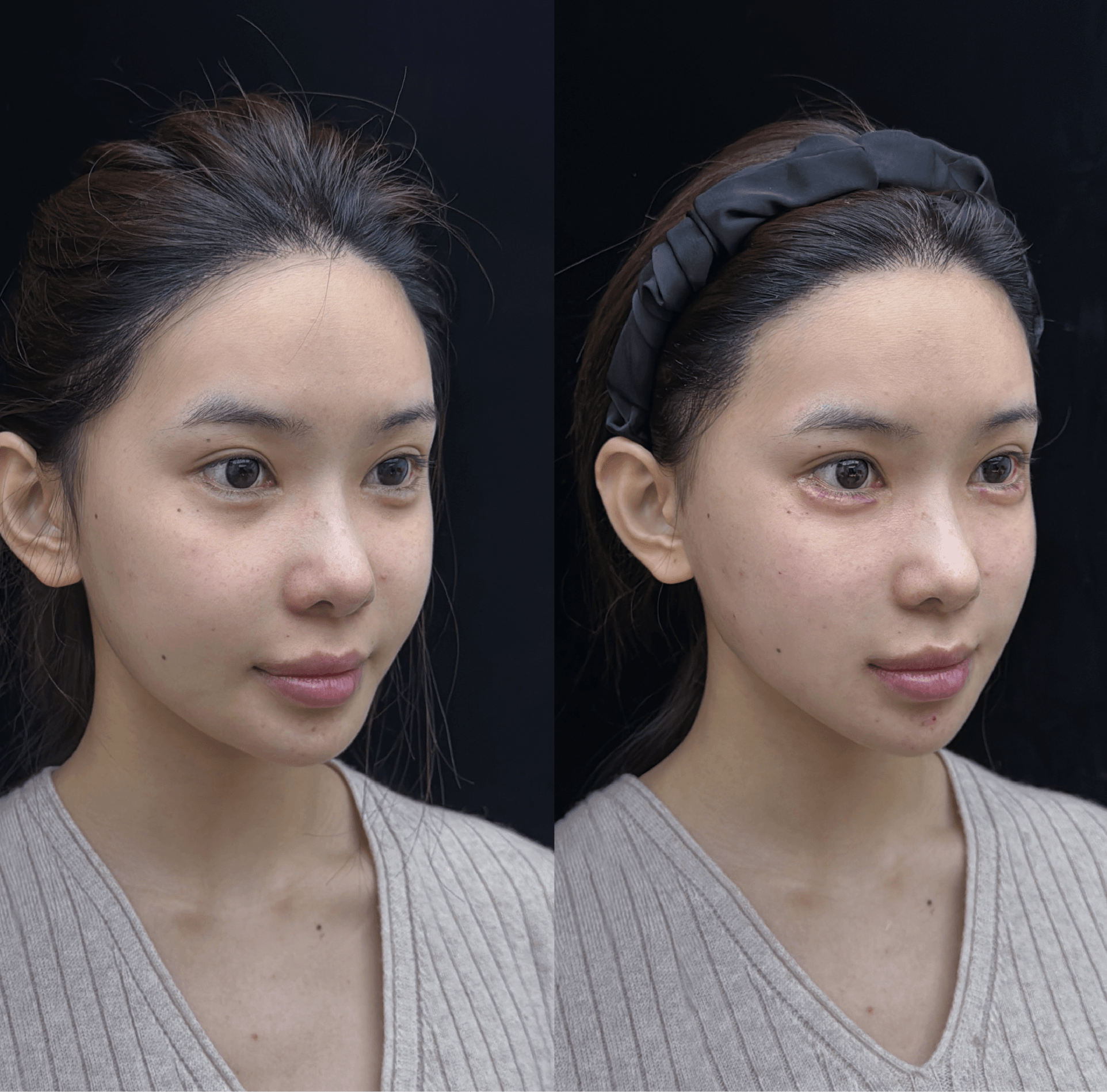 Facial injection side comparison