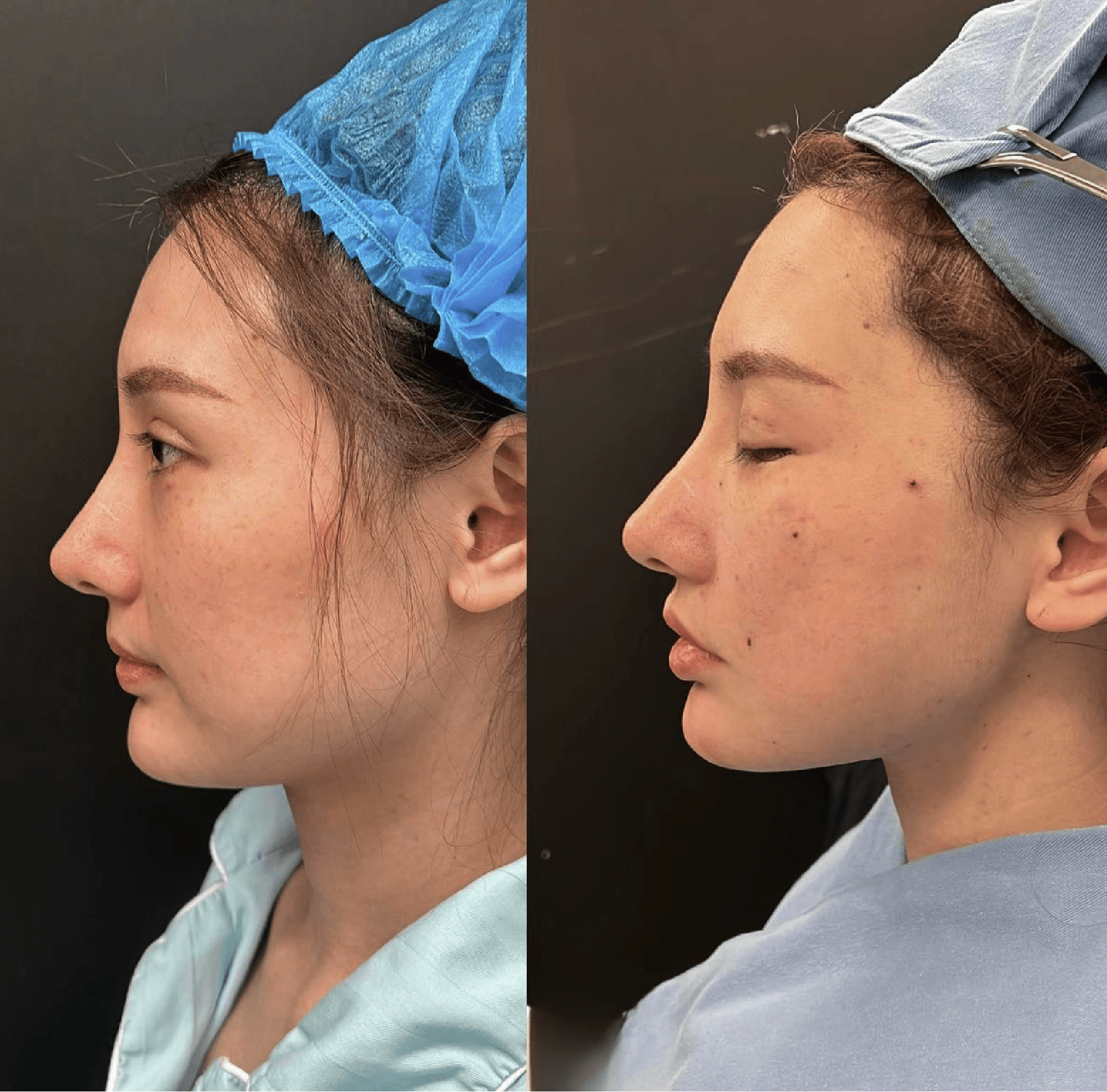 Facial lifting profile comparison