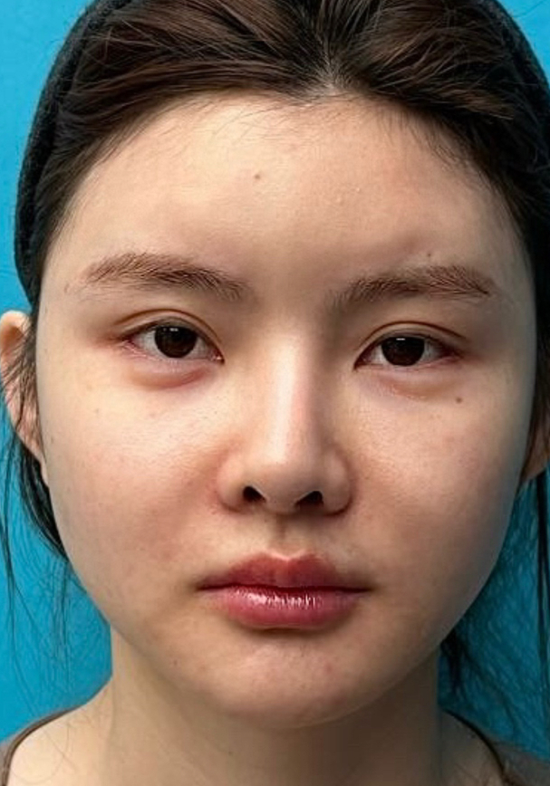 Facial contour after image