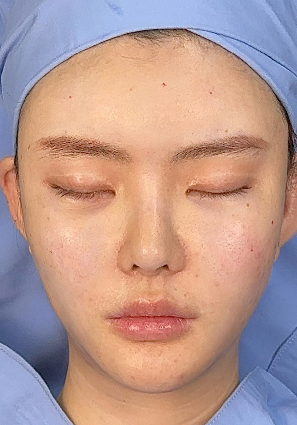 Facial contour before image