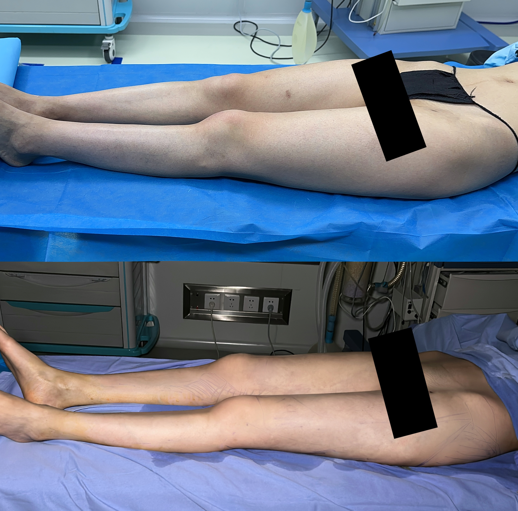 Lower body contour procedure comparison