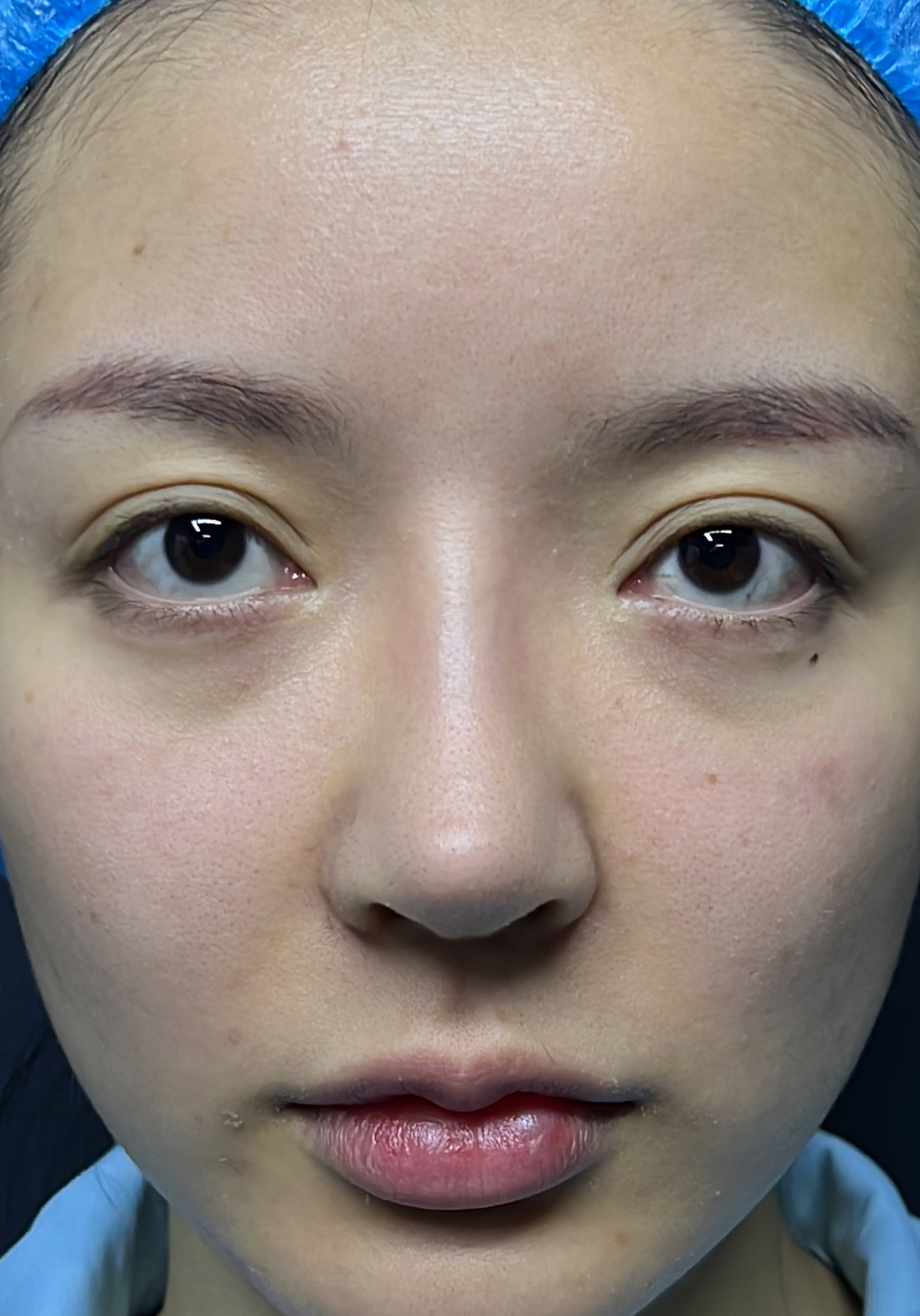 Nasal revision after image