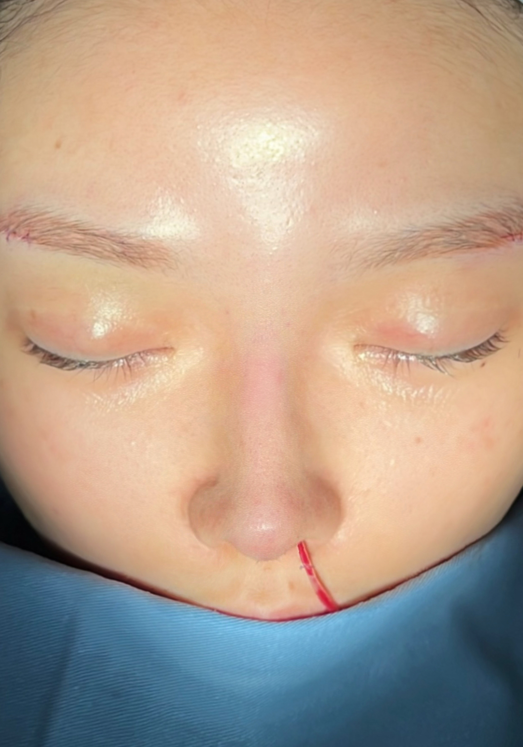 Nasal revision before image