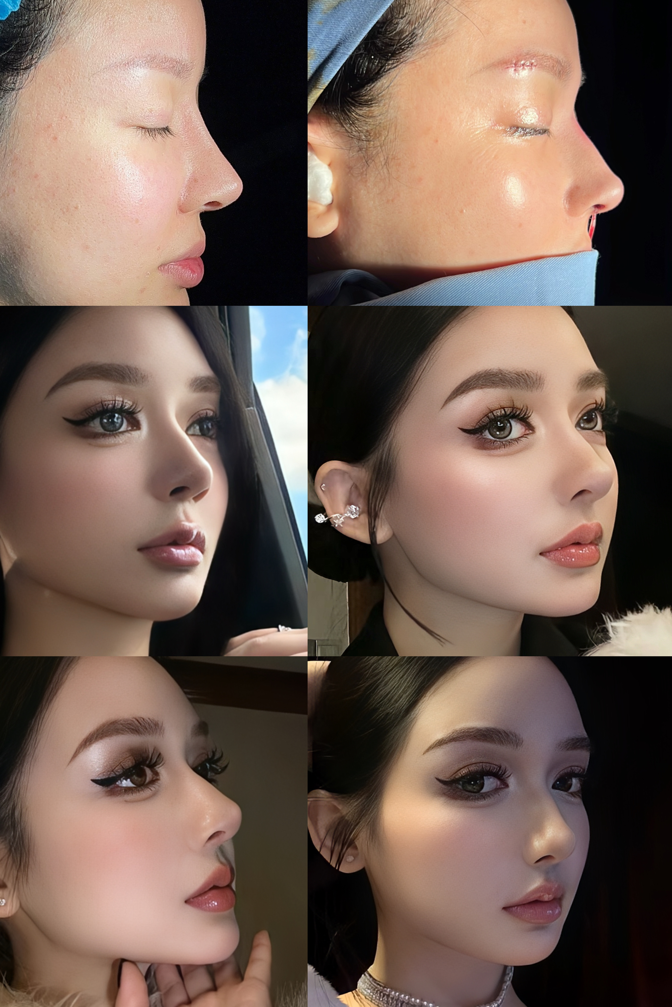 Nasal revision case collage