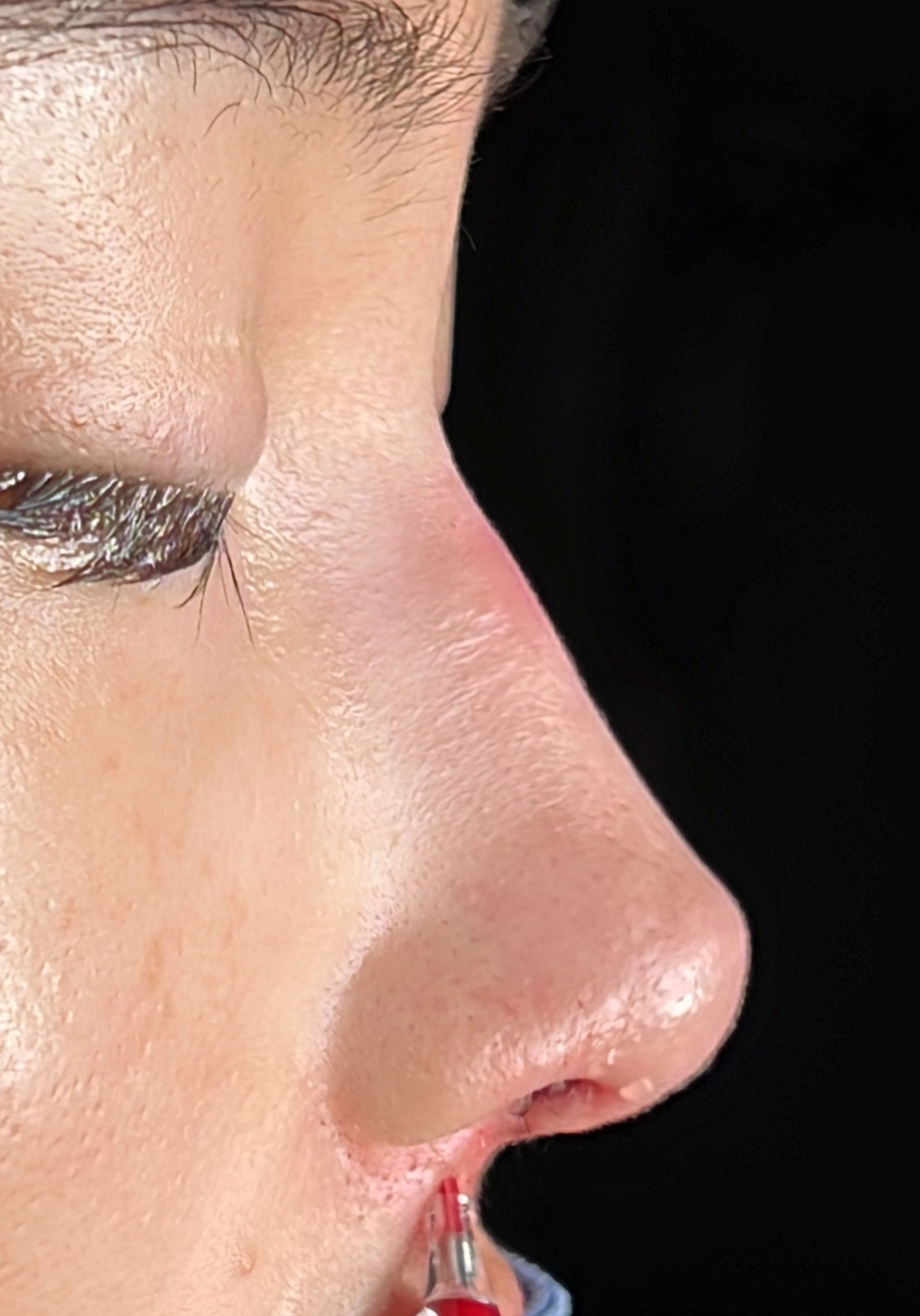 Primary rhinoplasty side profile after image