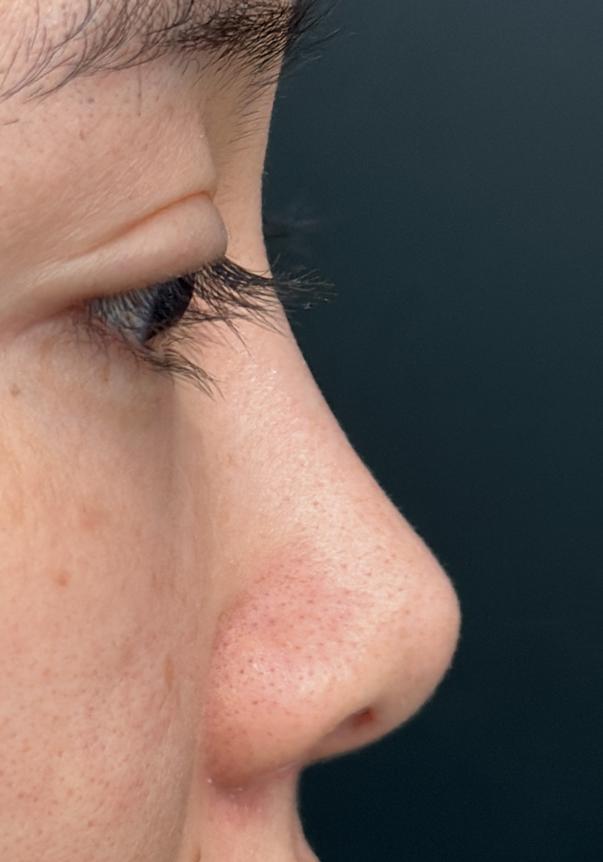 Primary rhinoplasty side profile before image