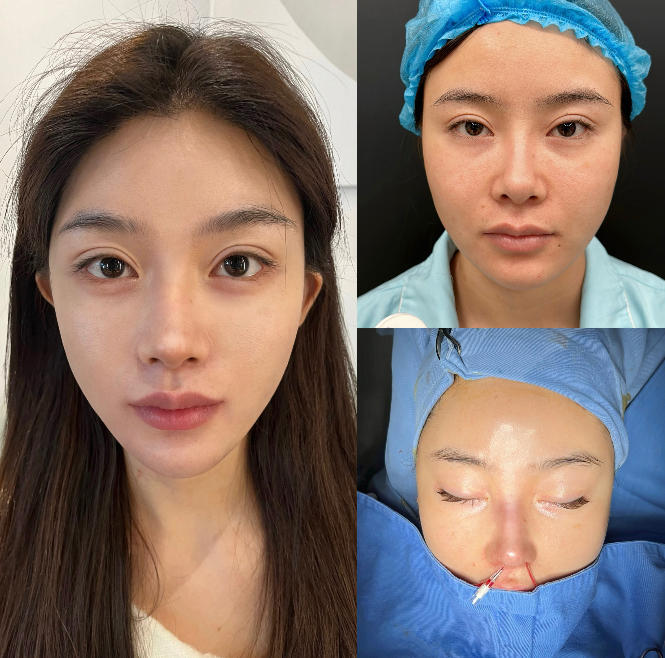 Primary rhinoplasty front comparison