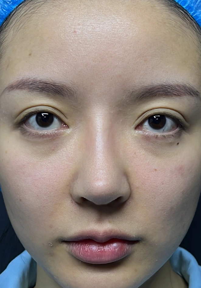 Revision rhinoplasty before