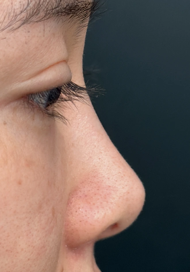 Primary rhinoplasty before