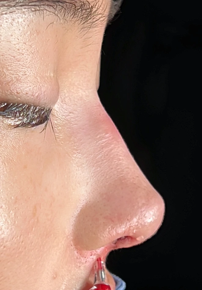 Primary rhinoplasty after