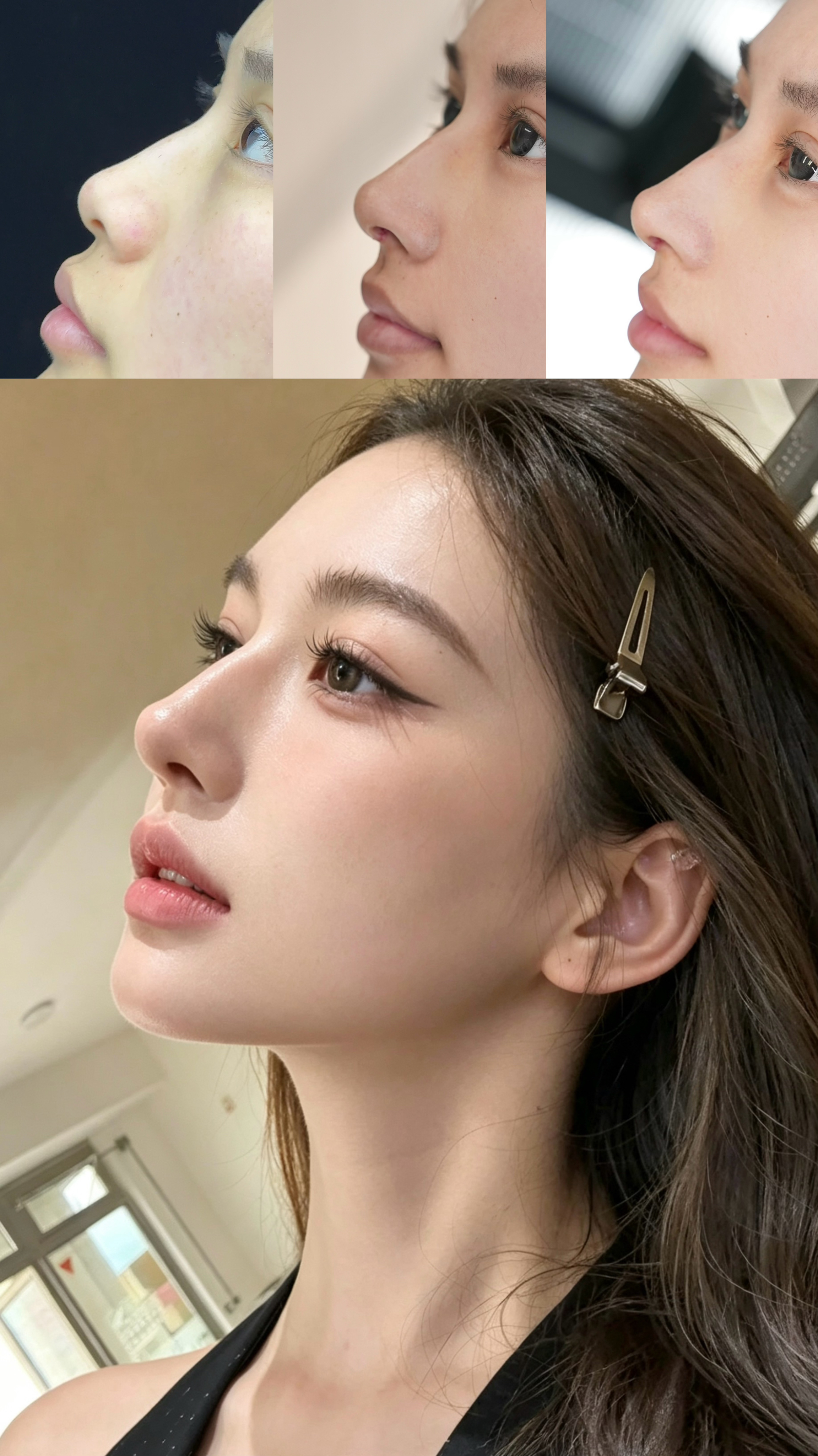 Rhinoplasty result collage