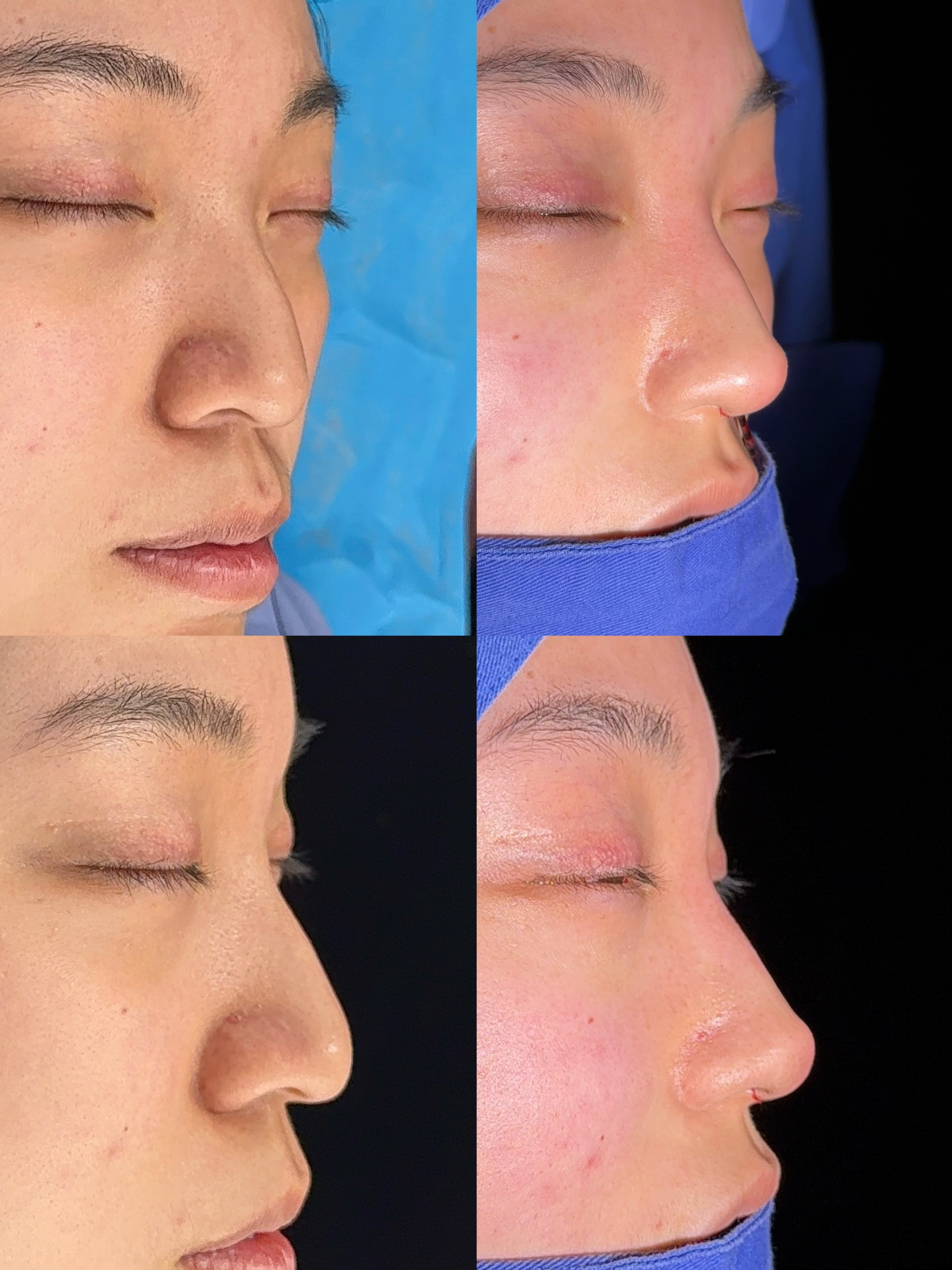 Rhinoplasty clinical comparison