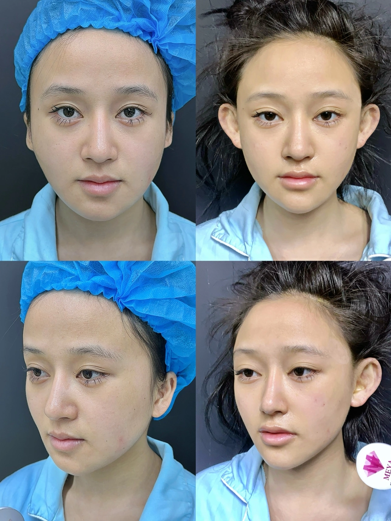 Facial implant contouring before