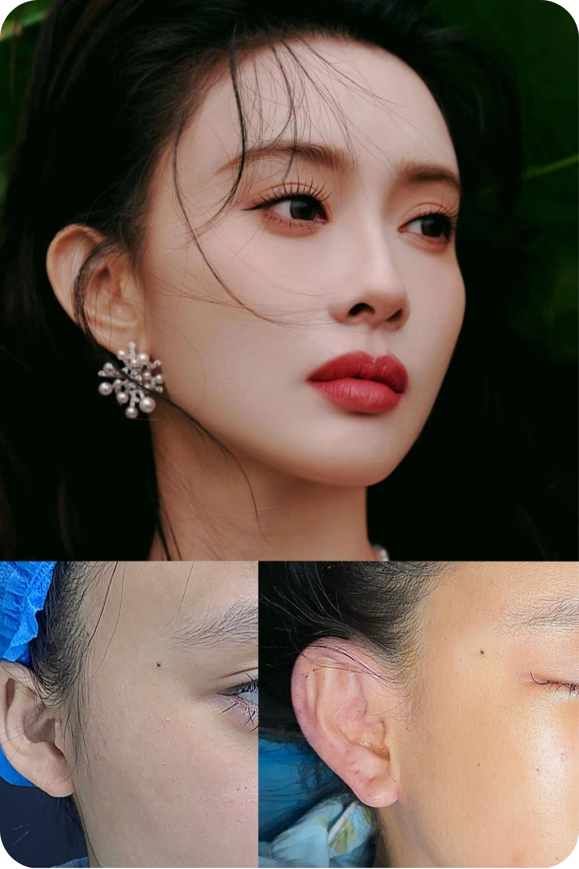 Facial implant contouring result collage