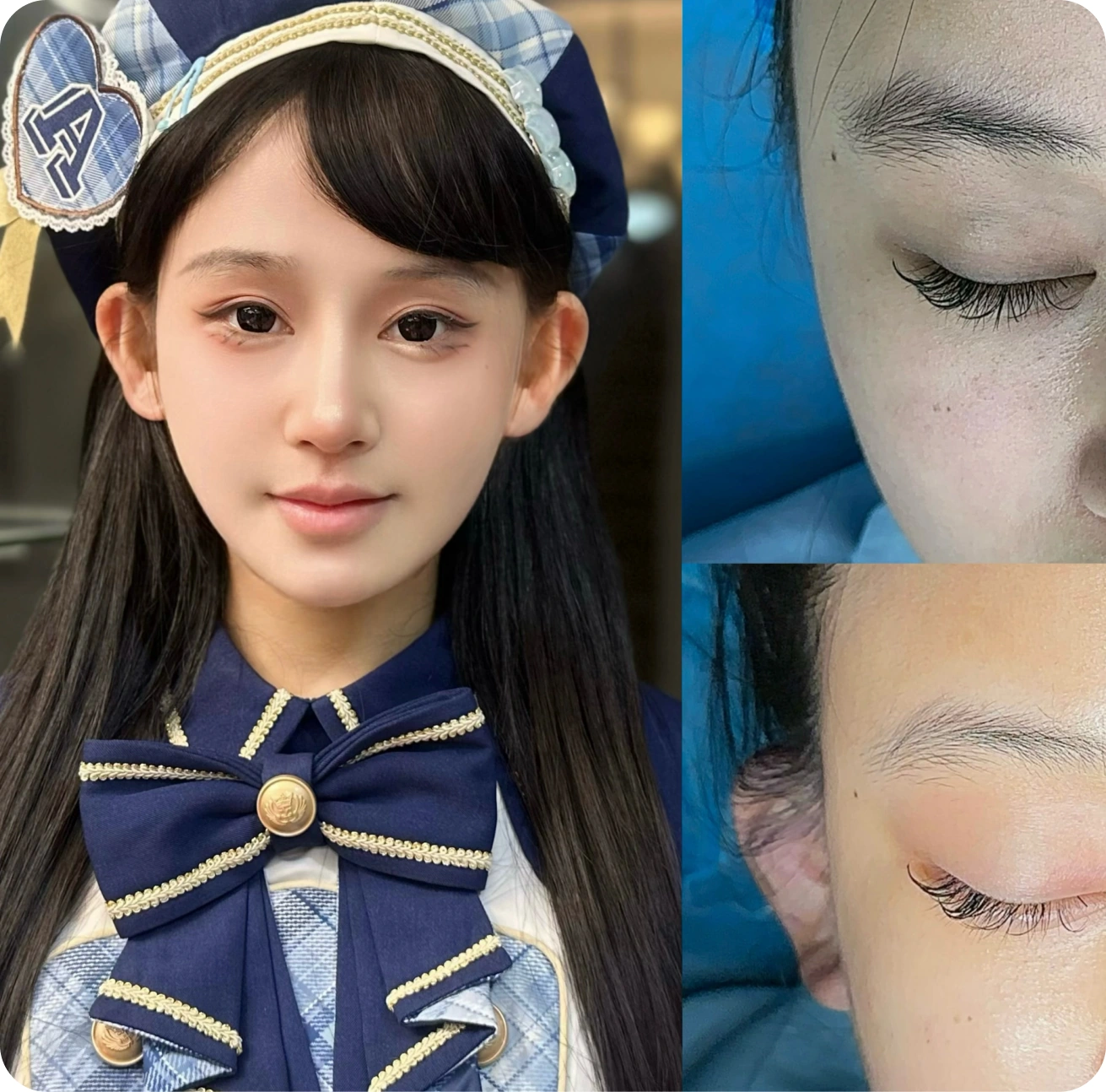 Facial implant contouring comparison
