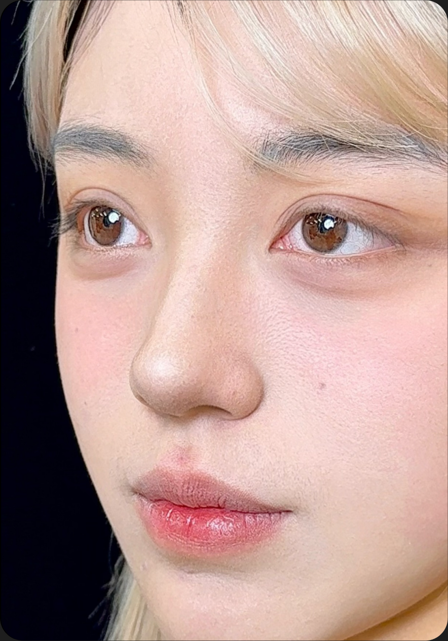 Rhinoplasty before