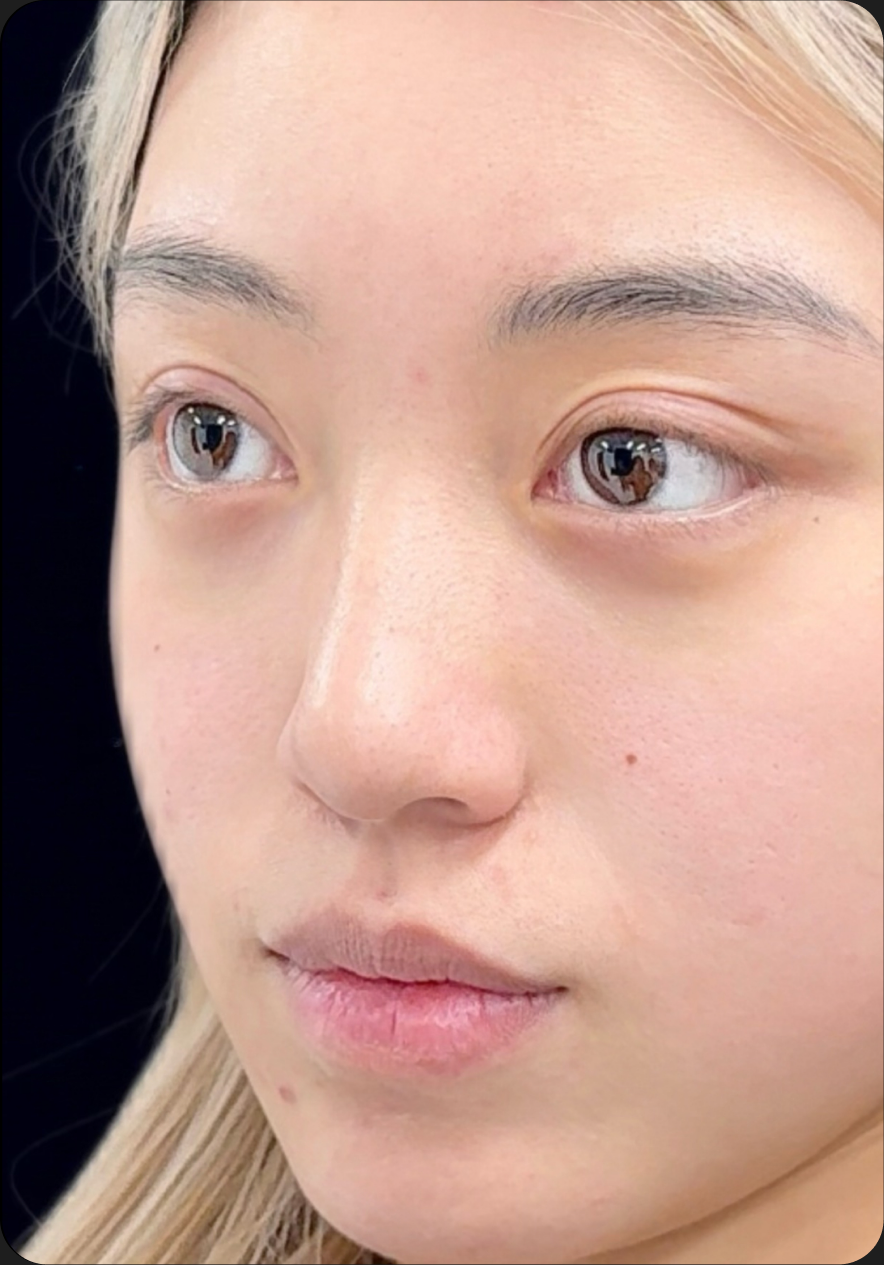 Rhinoplasty after