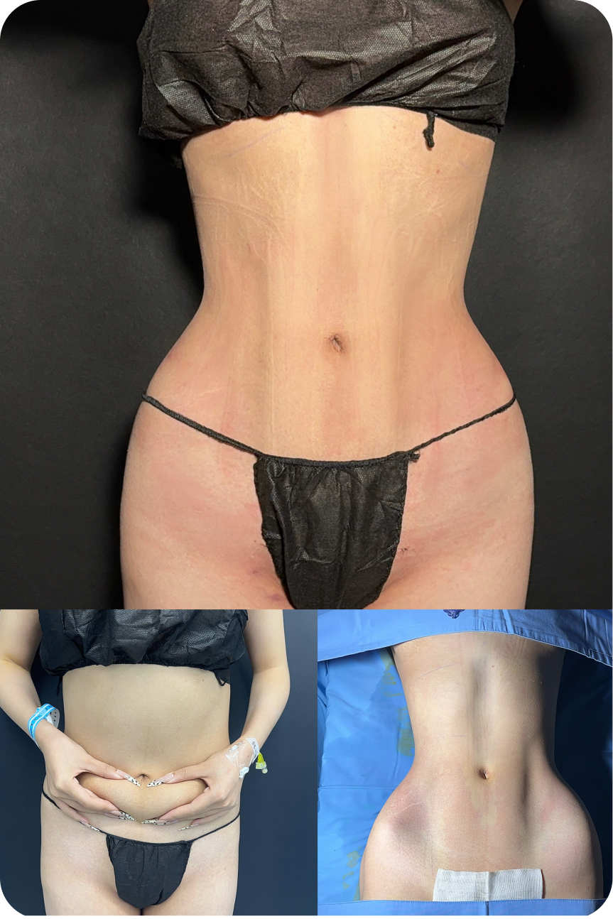 Body contouring result collage