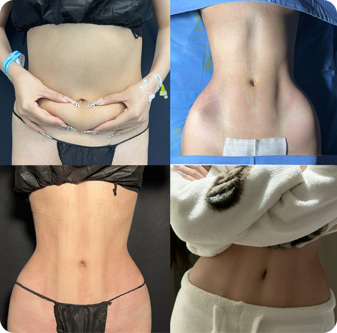 Waist and abdominal contouring results