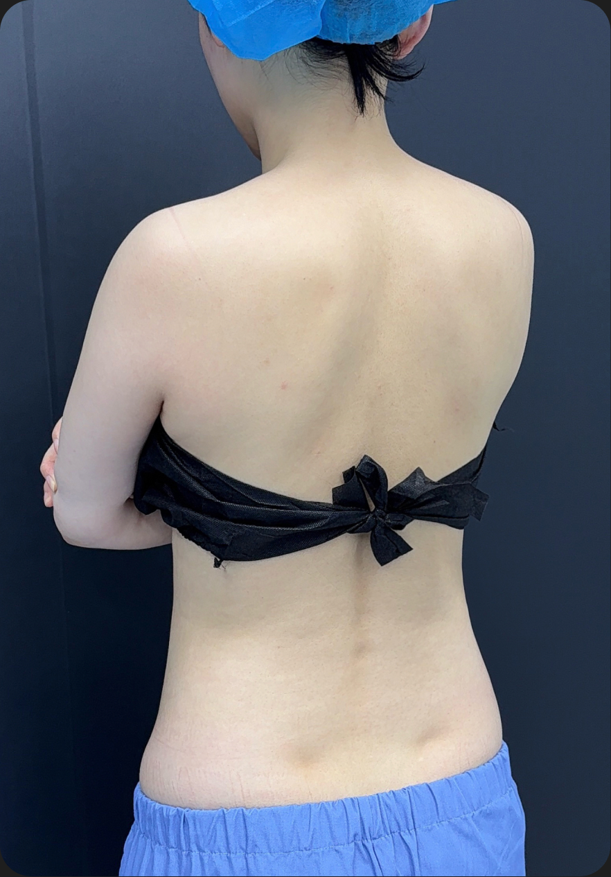 Body contouring before