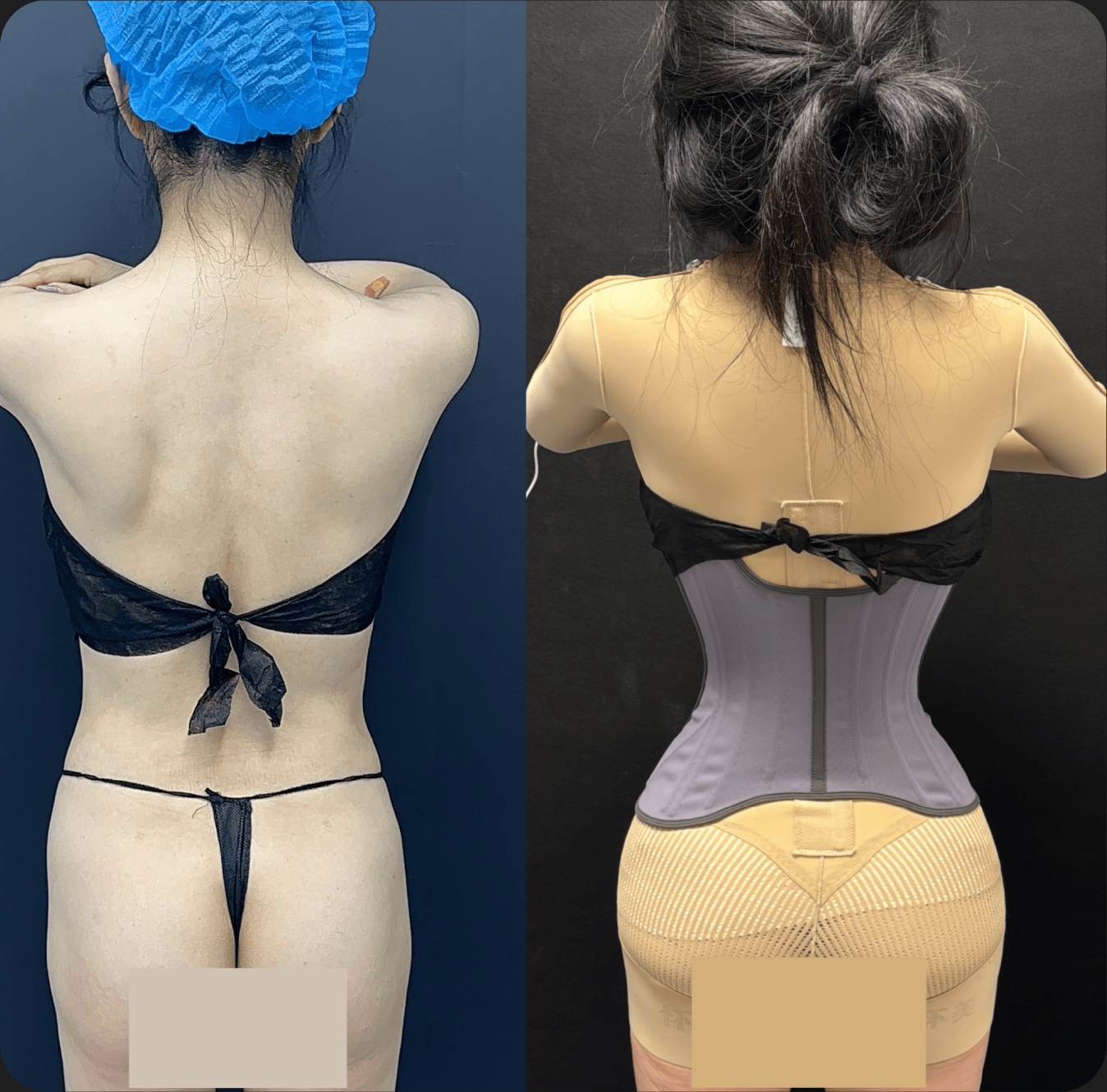Rib push-in case comparison