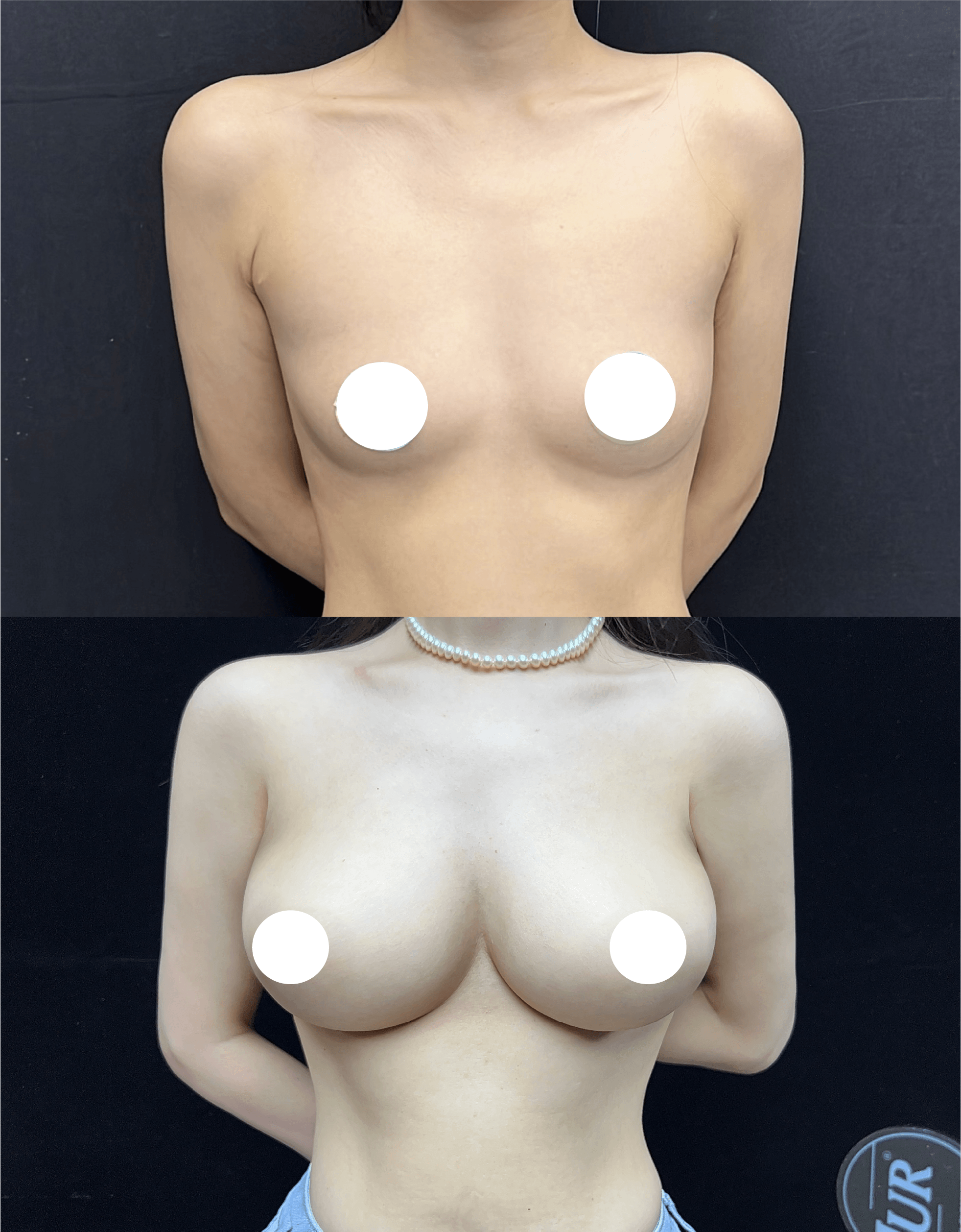 Breast augmentation case comparison