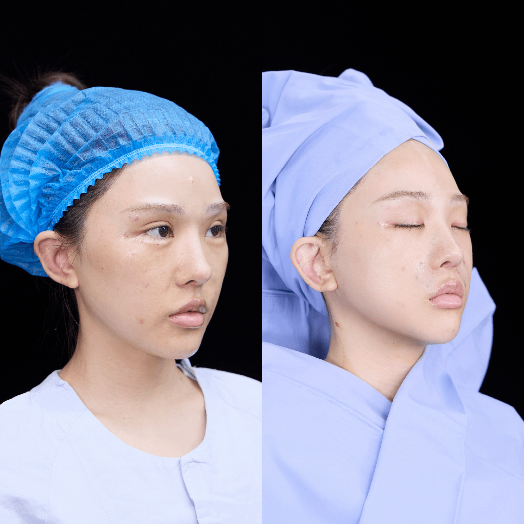 Facial lifting case comparison