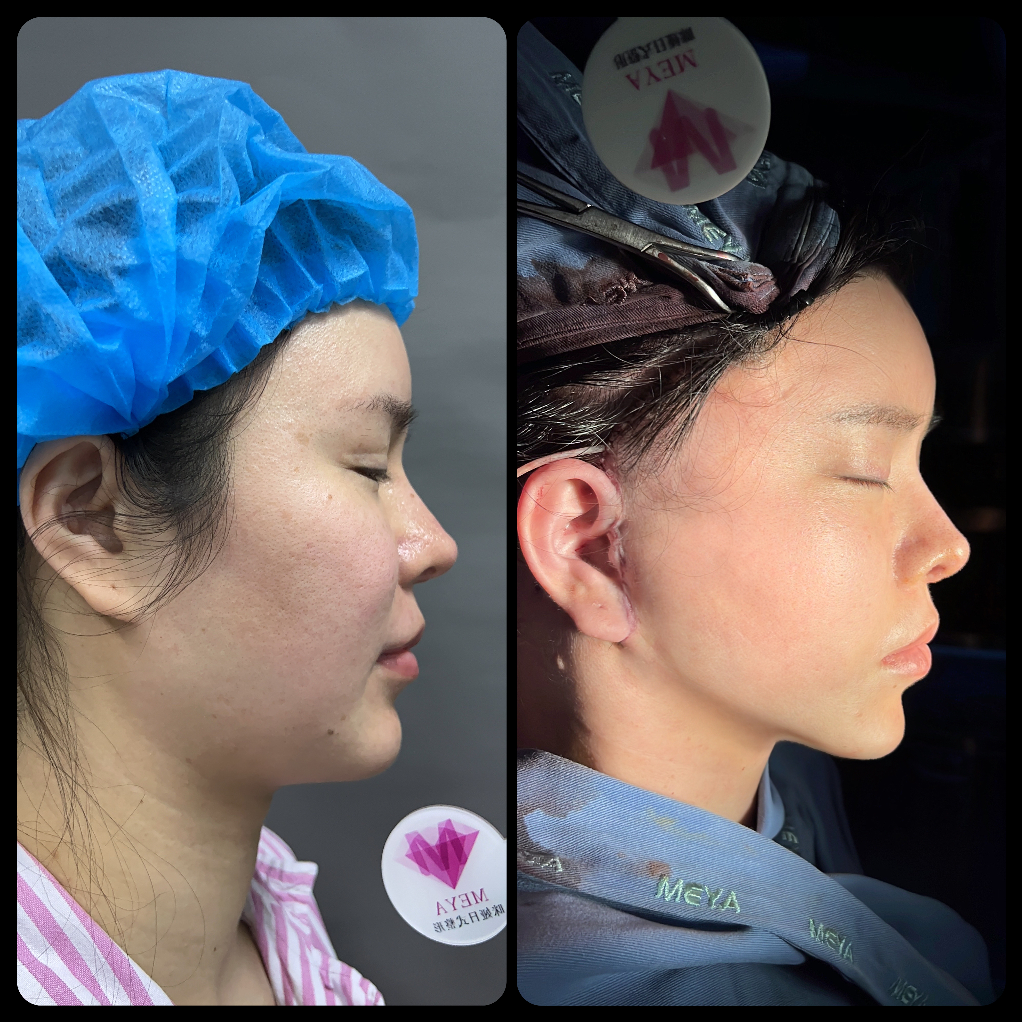 Mini facelift before image