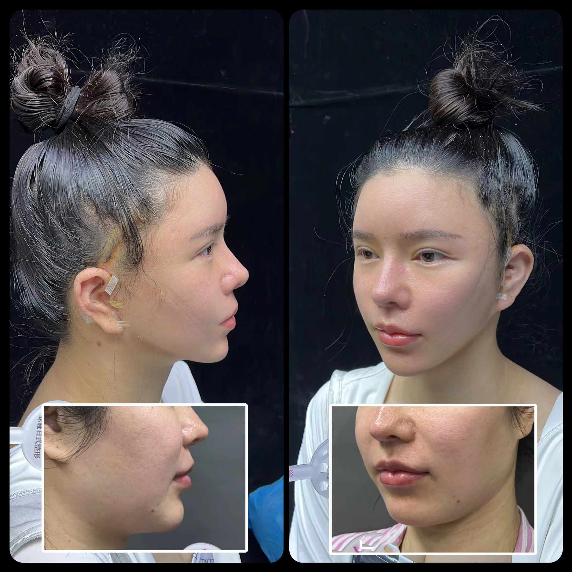 Mini facelift case comparison