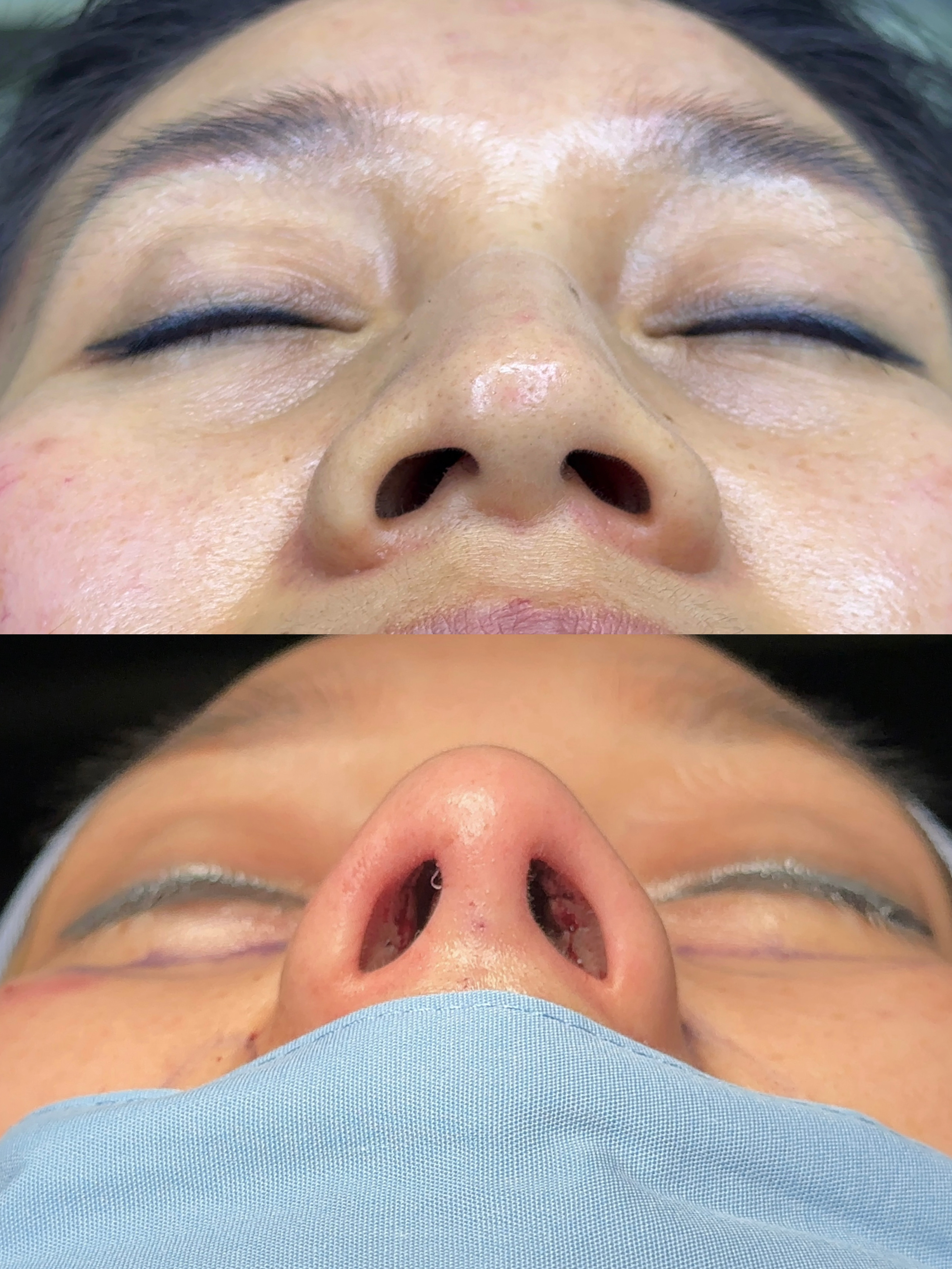 Rhinoplasty case comparison