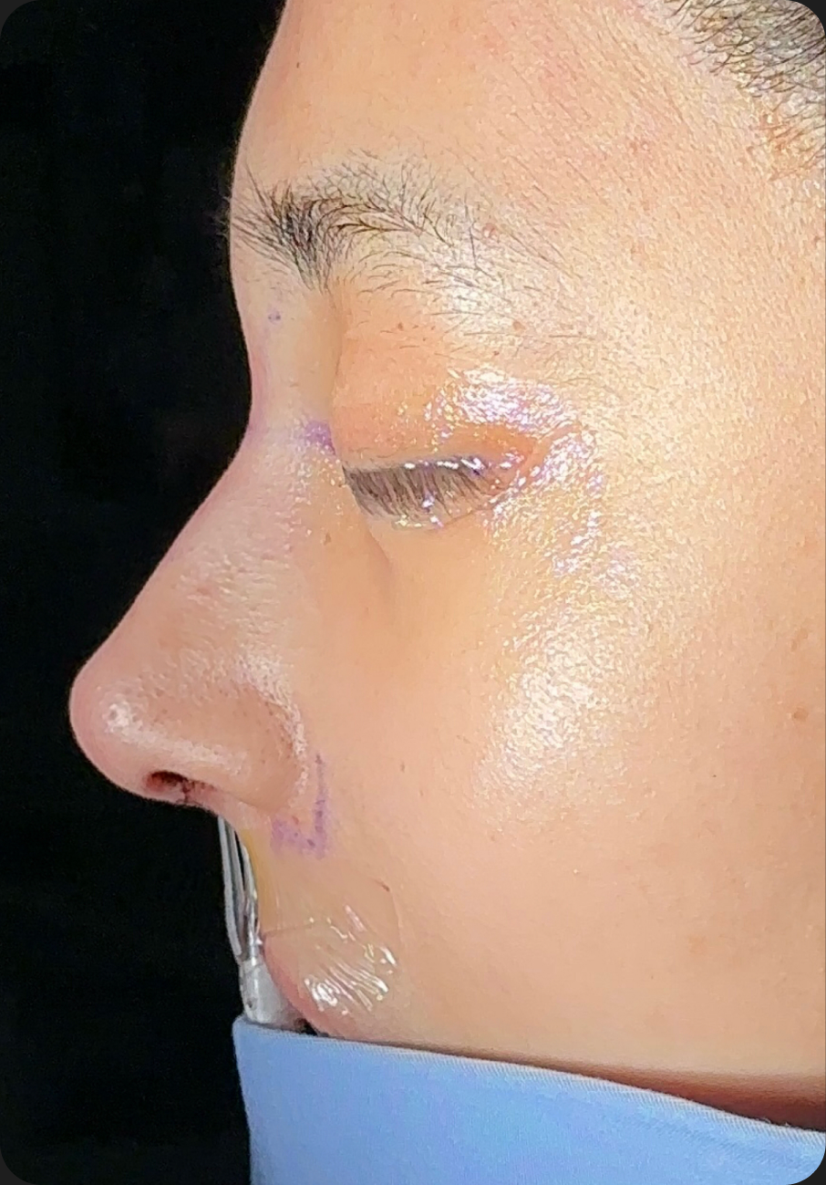 Rhinoplasty before image